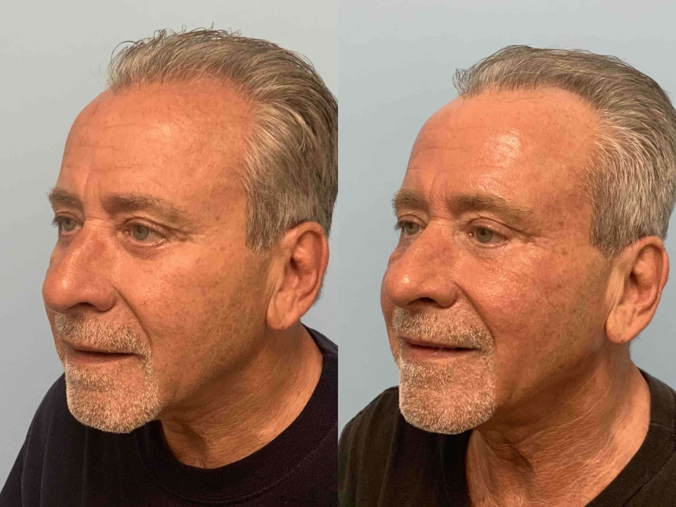 Before and after, 11 months post op from Lower Lid Blepharoplasty/Canthopexy, Sculptra Injectable, performed by Dr. Paul Vanek (diagonal view)