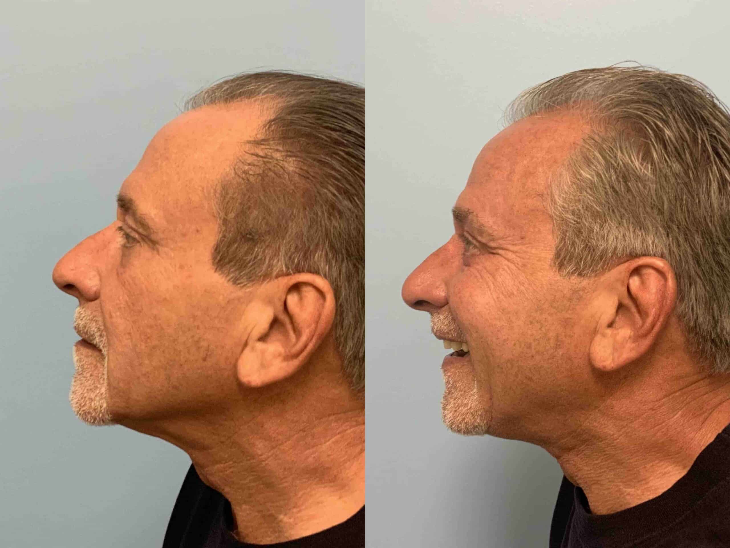 Before and after, 11 months post op from Lower Lid Blepharoplasty/Canthopexy, Sculptra Injectable, performed by Dr. Paul Vanek (side view)