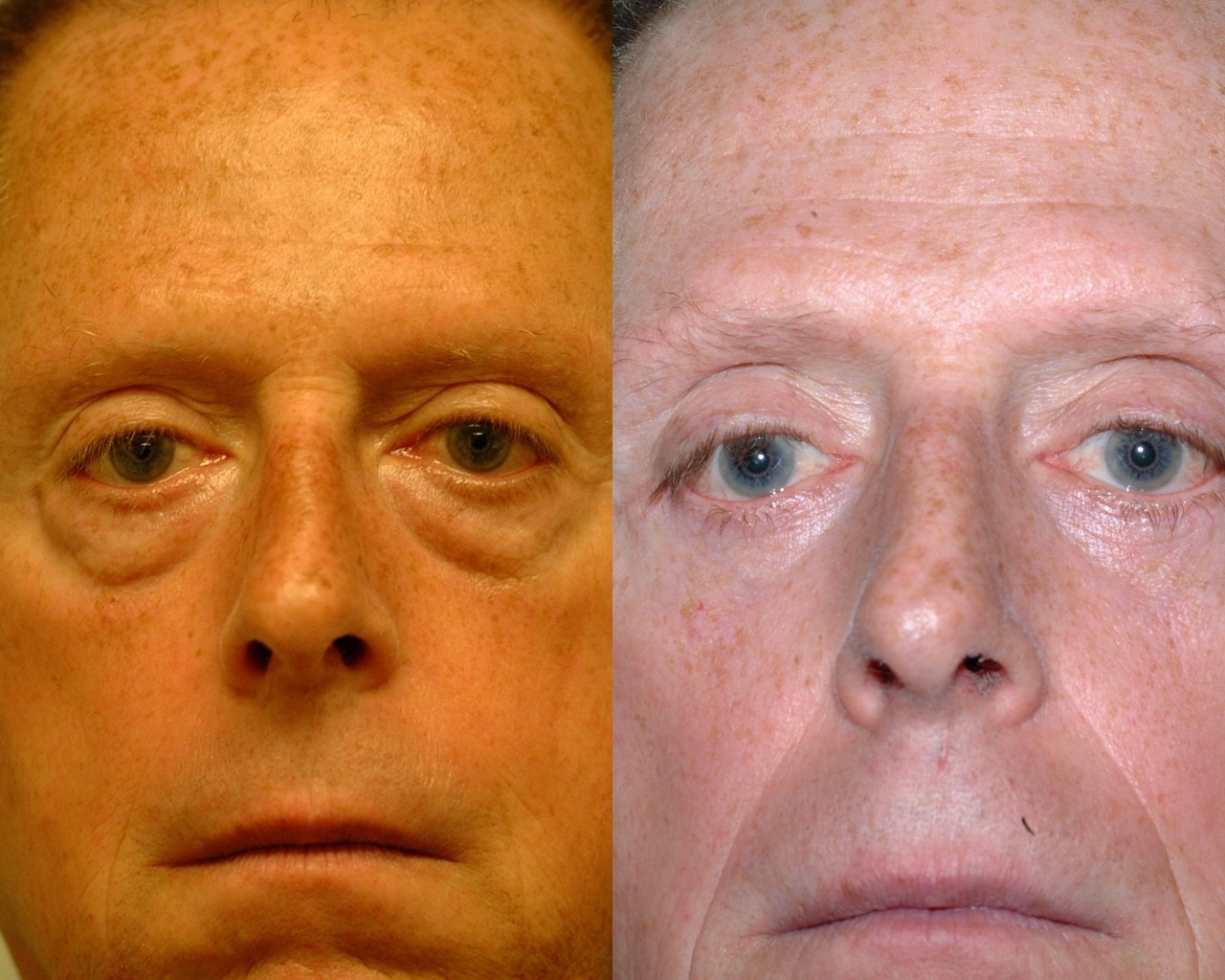 Before and after, 7 mo post op from Lower Blepharoplasty, Canthopexy performed by Dr. Paul Vanek (front view)