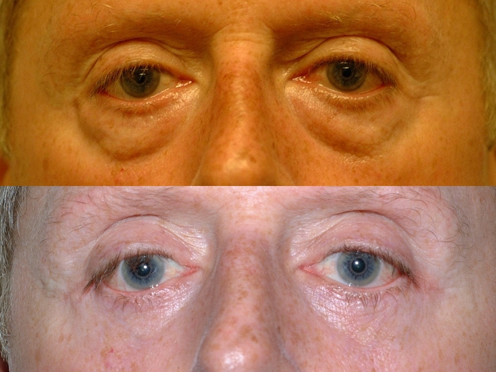Before and after, 7 mo post op from Lower Blepharoplasty, Canthopexy performed by Dr. Paul Vanek (close up of eyes)