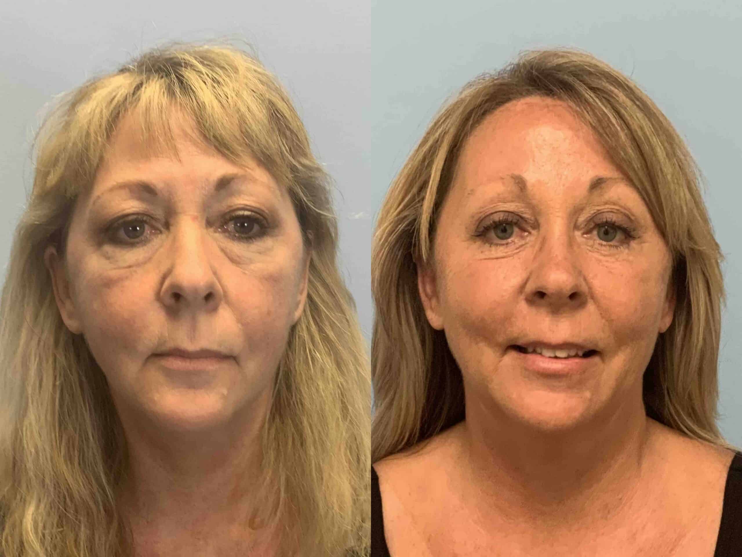 Before and after, 1 year/8 mo post op from Upper and Lower Blepharoplasty, Autologous Fat Transfer to Face, Endo Brow Lift performed by Dr. Paul Vanek (front view)