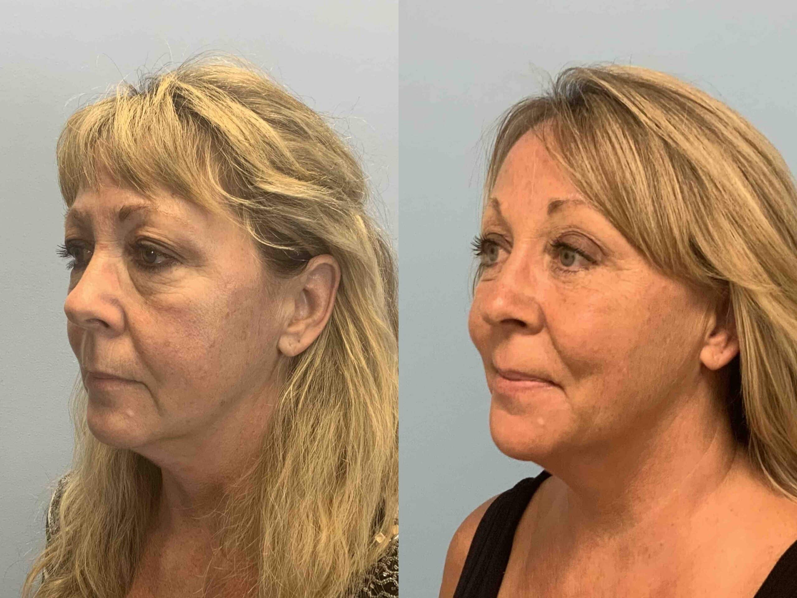 Before and after, 1 year/8 mo post op from Upper and Lower Blepharoplasty, Autologous Fat Transfer to Face, Endo Brow Lift performed by Dr. Paul Vanek (diagonal view)