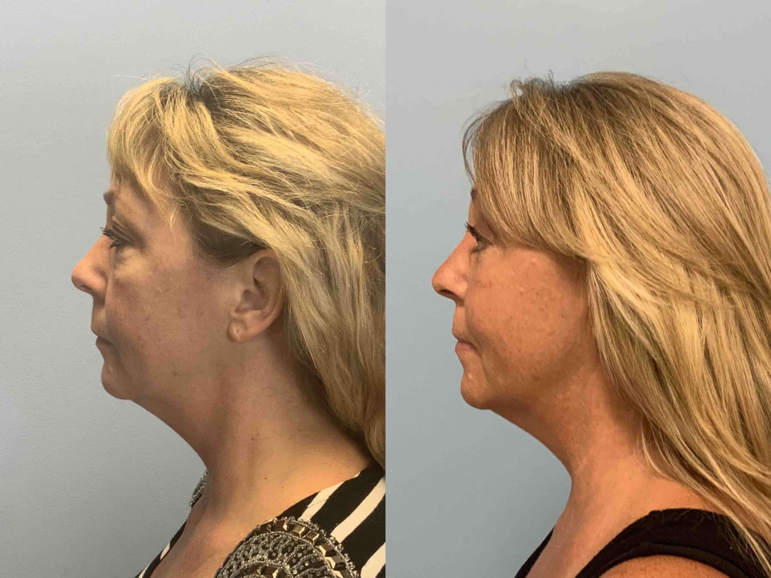 Before and after, 1 year/8 mo post op from Upper and Lower Blepharoplasty, Autologous Fat Transfer to Face, Endo Brow Lift performed by Dr. Paul Vanek (side view)