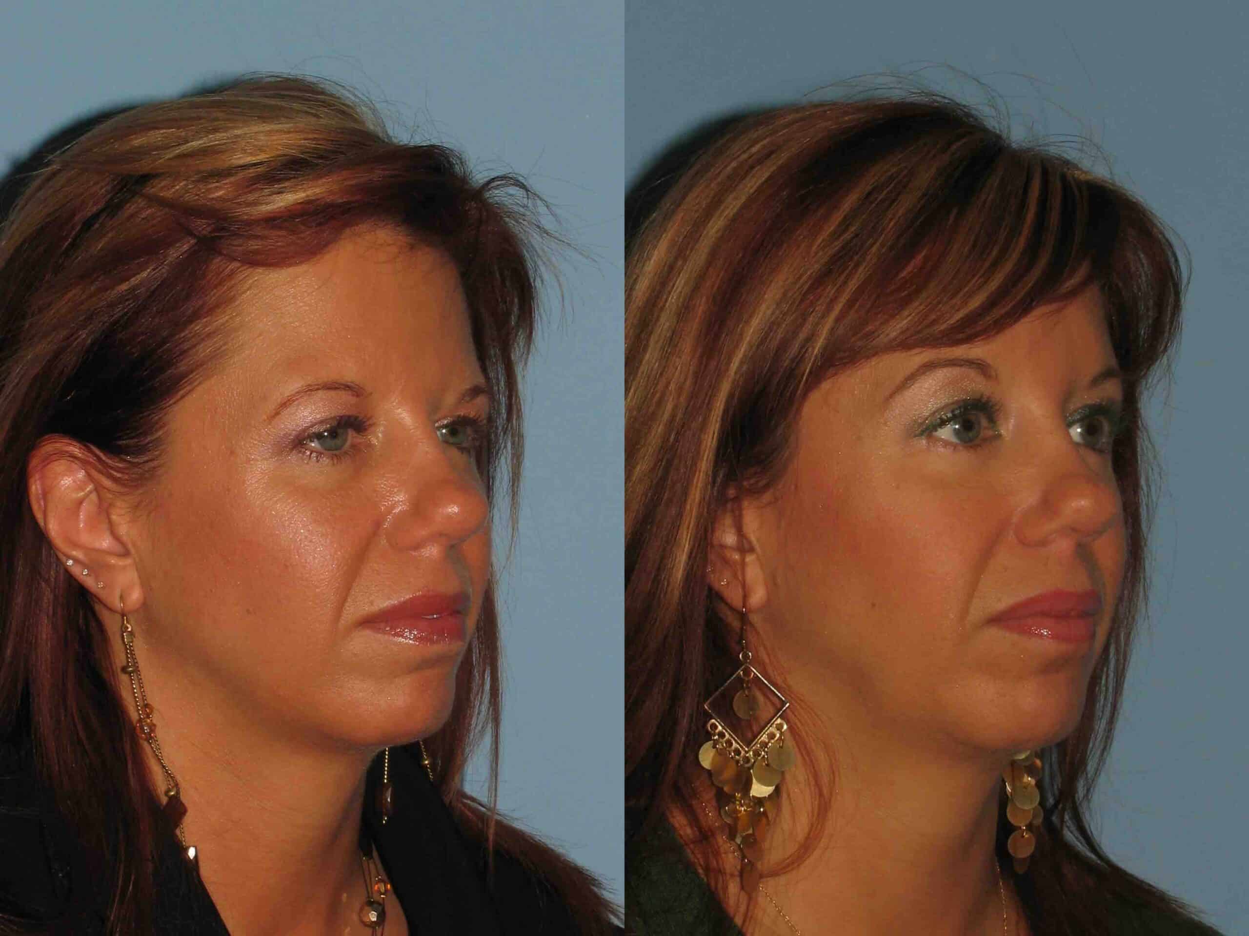Before and after, 6 mo post op from Lower Blepharoplasty, Endo Brow Lift (diagonal view)
