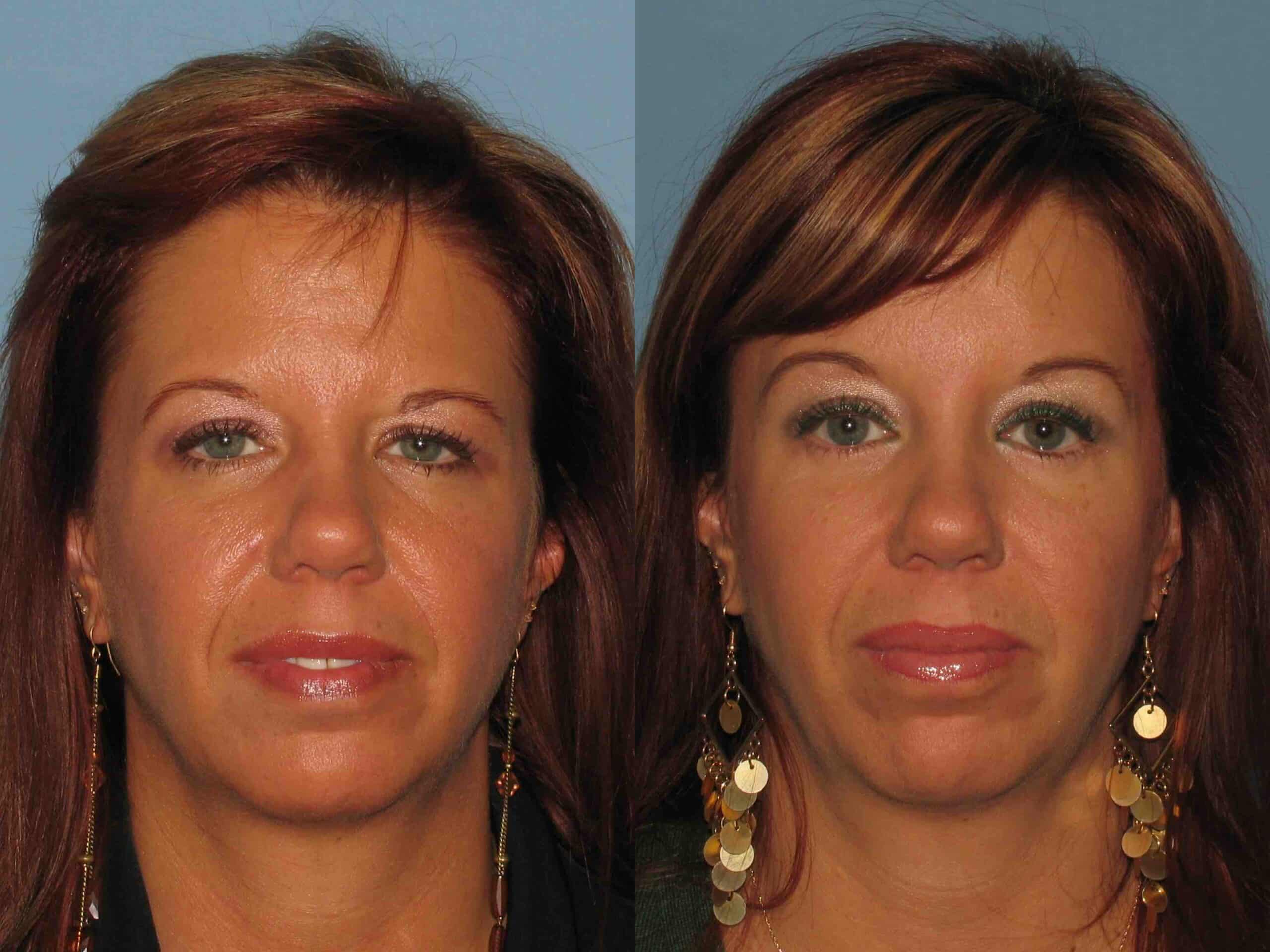 Before and after, 6 mo post op from Lower Blepharoplasty, Endo Brow Lift (front view)
