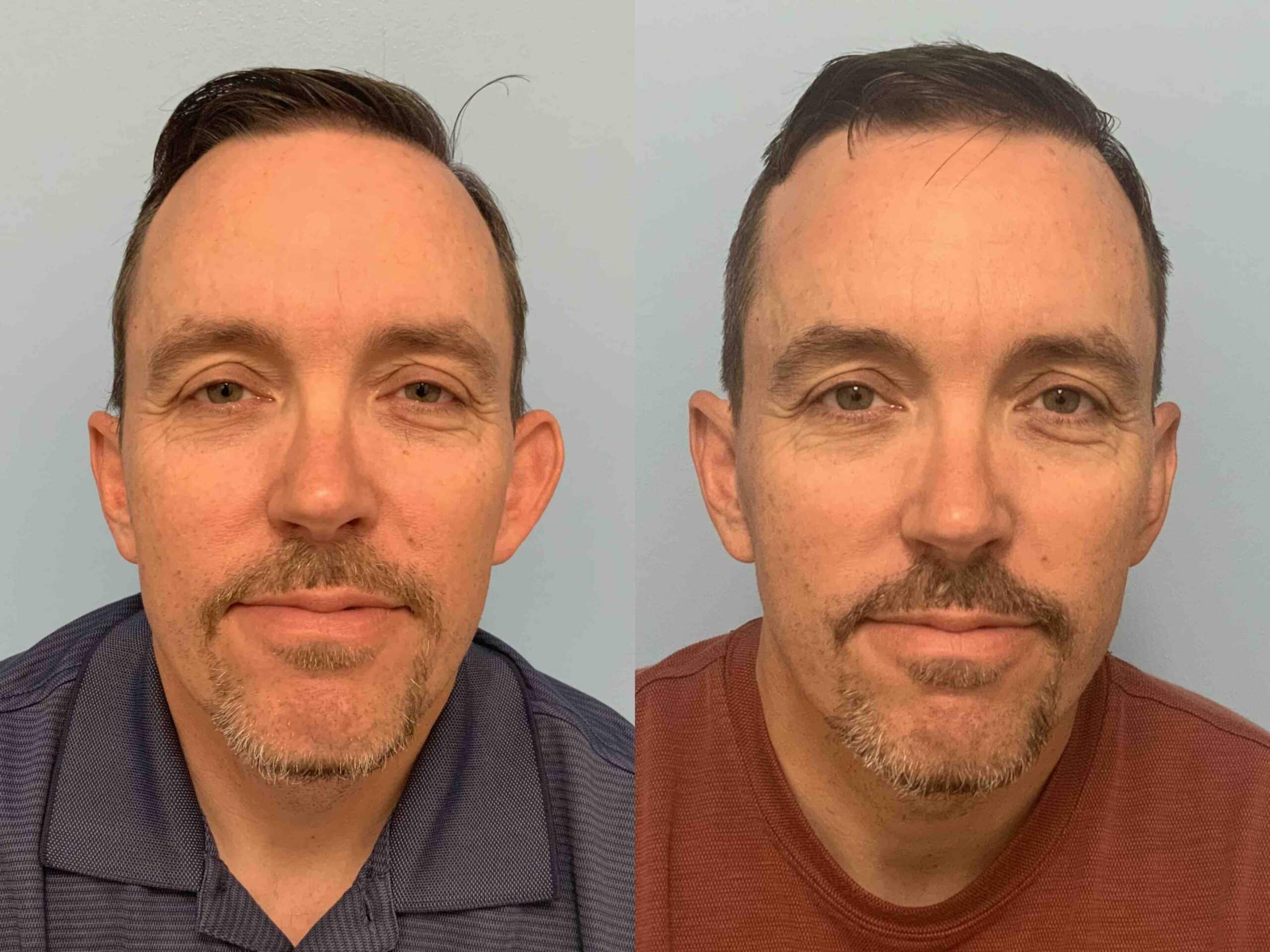 Before and after, 3 mo post op from left ear otoplasty performed by Dr. Paul Vanek (front view)
