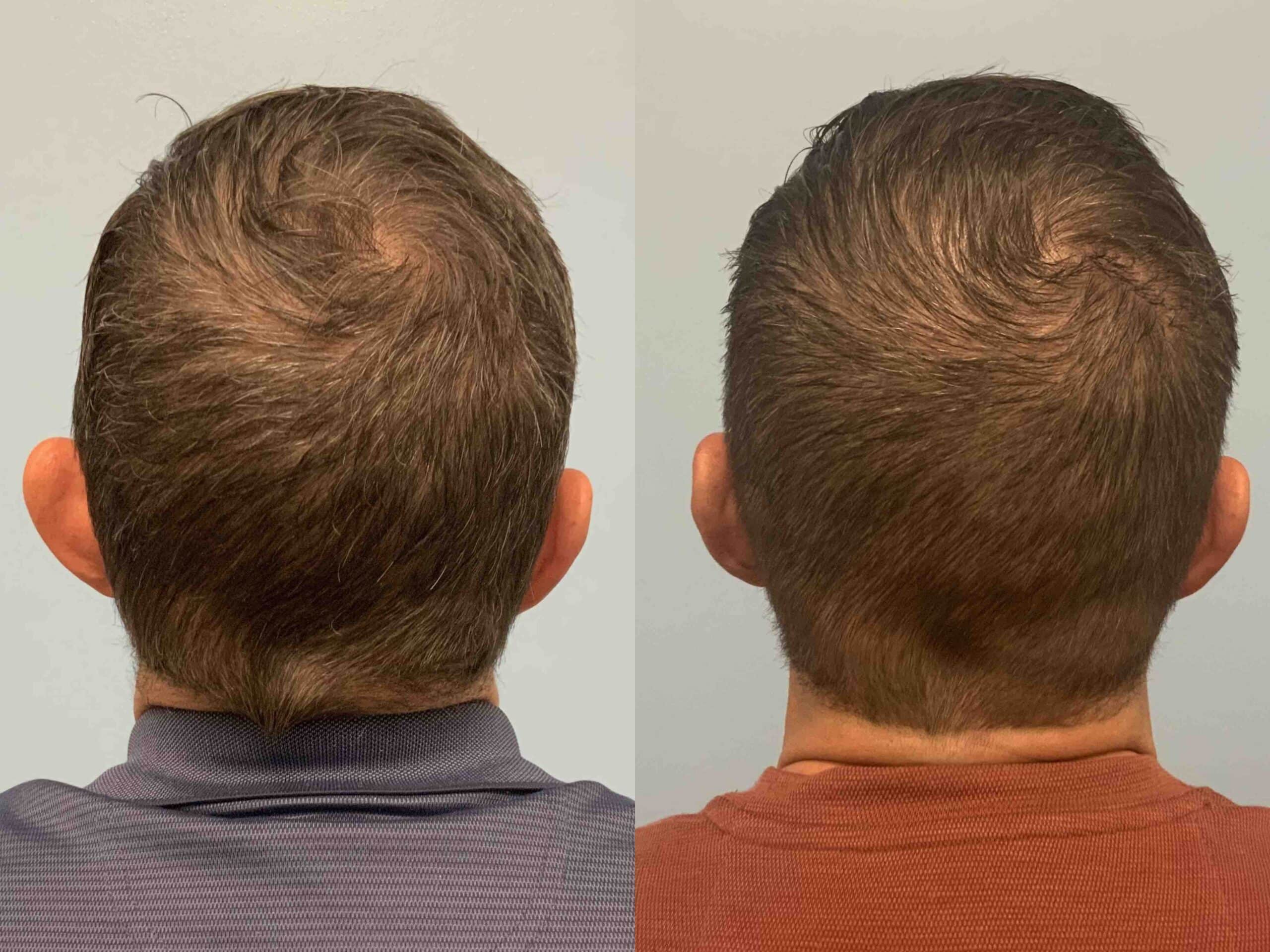 Before and after, 3 mo post op from left ear otoplasty performed by Dr. Paul Vanek (back view)