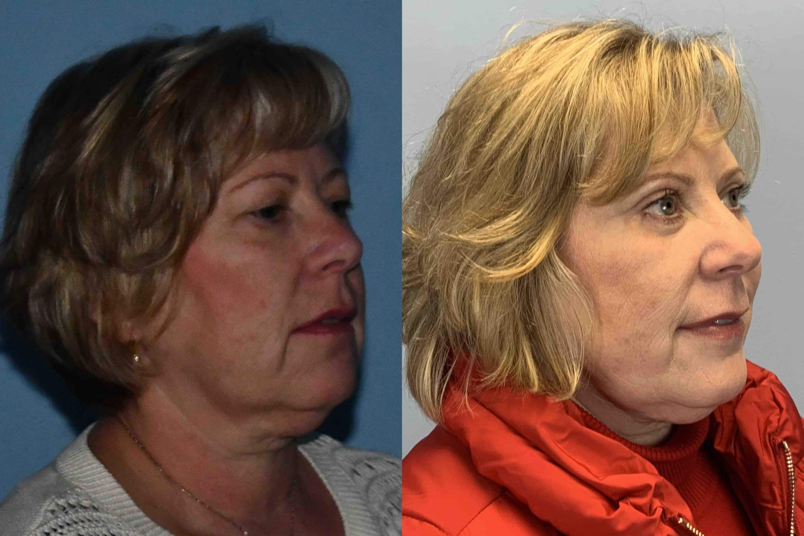 Before and after, 3 mo post op from Upper and Lower Blepharoplasty, Canthopexy (diagonal view)