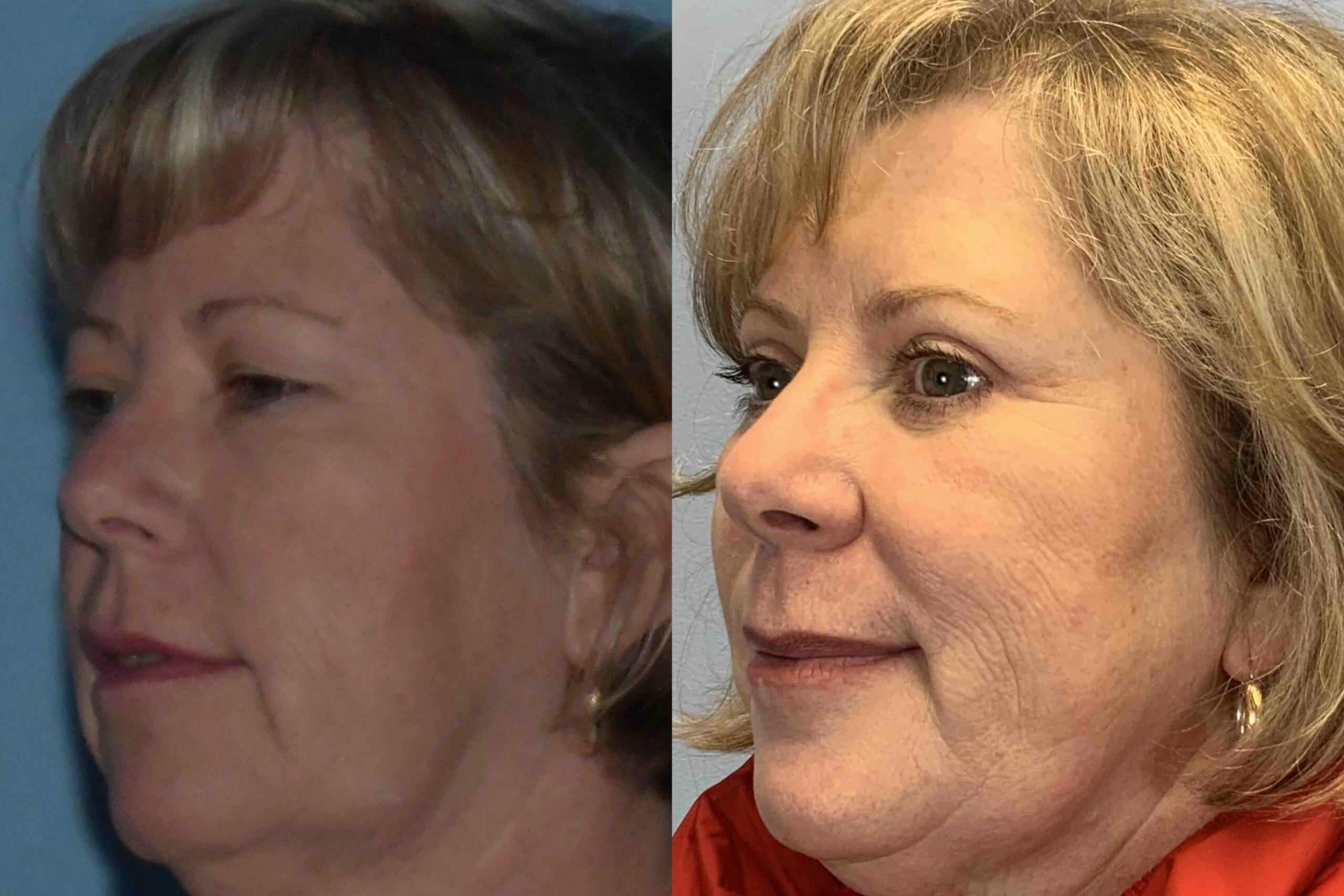 Before and after, 3 mo post op from Upper and Lower Blepharoplasty, Canthopexy (side view)