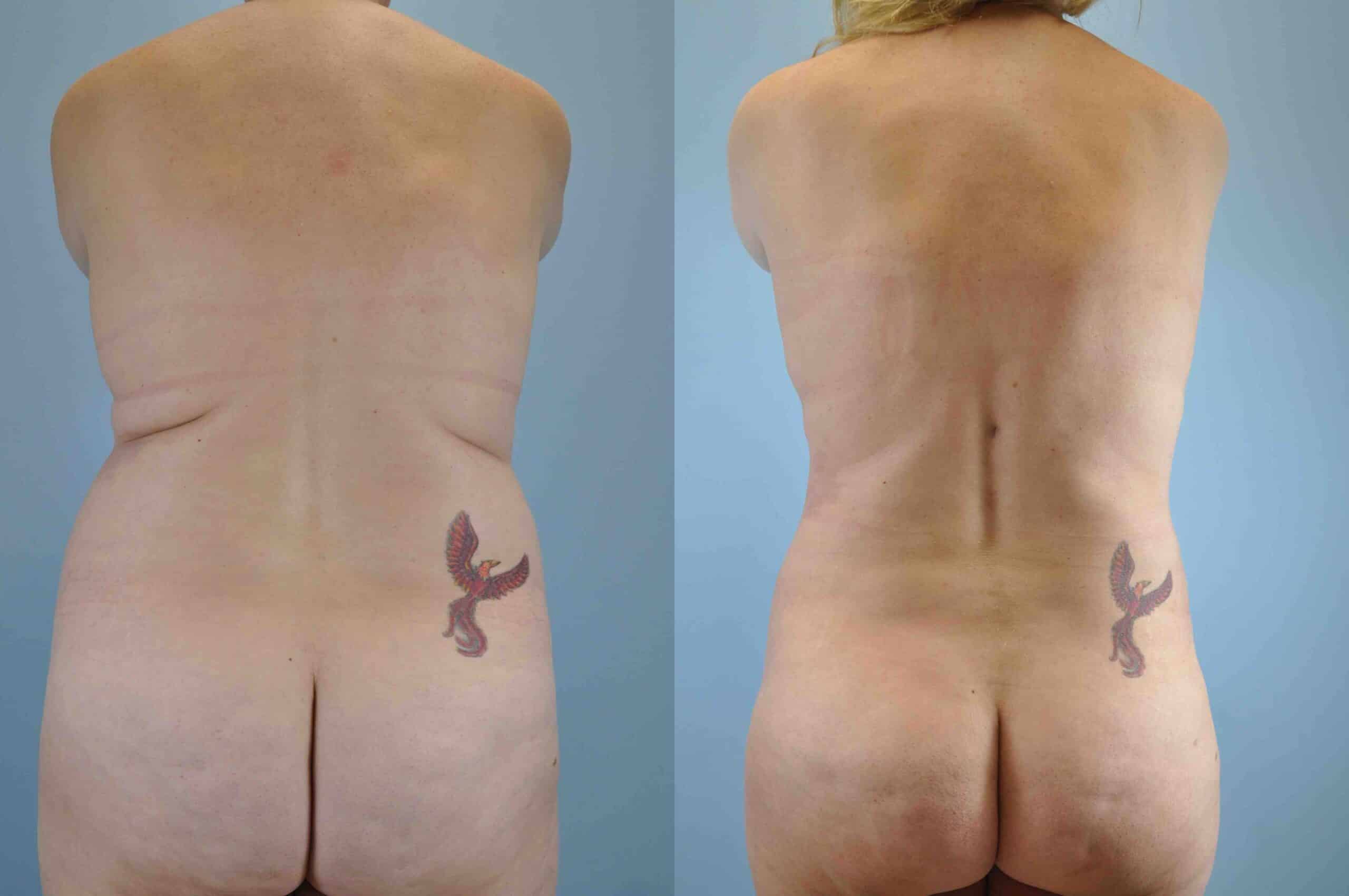 Before and after, 1 yr post op from Tummy Tuck, Breast Lift/Mastopexy, VASER Abdomen Flanks & Back performed by Dr. Paul Vanek (rear view)