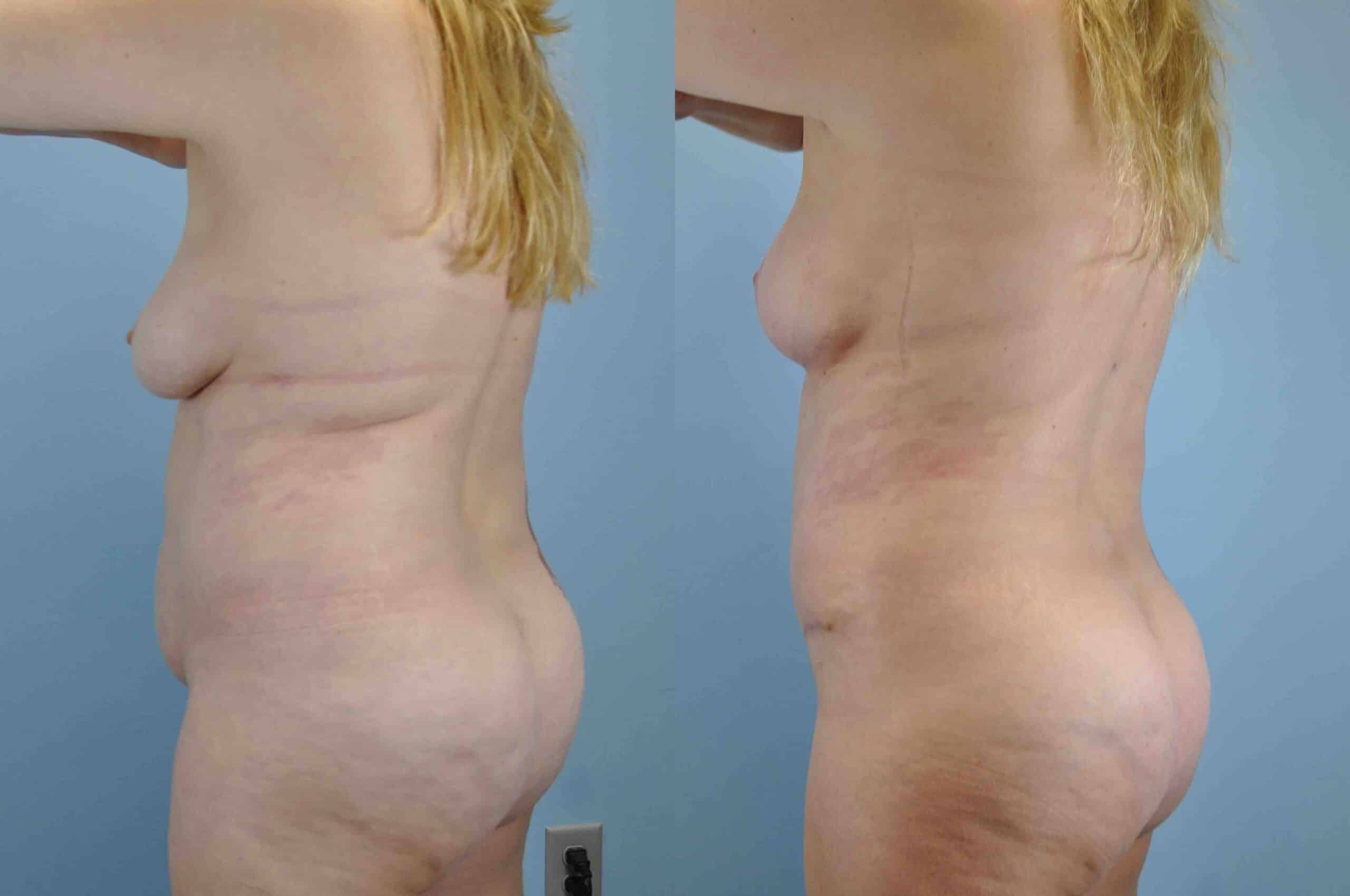 Before and after, 1 yr post op from Tummy Tuck, Breast Lift/Mastopexy, VASER Abdomen Flanks & Back performed by Dr. Paul Vanek (diagonal/rear view)