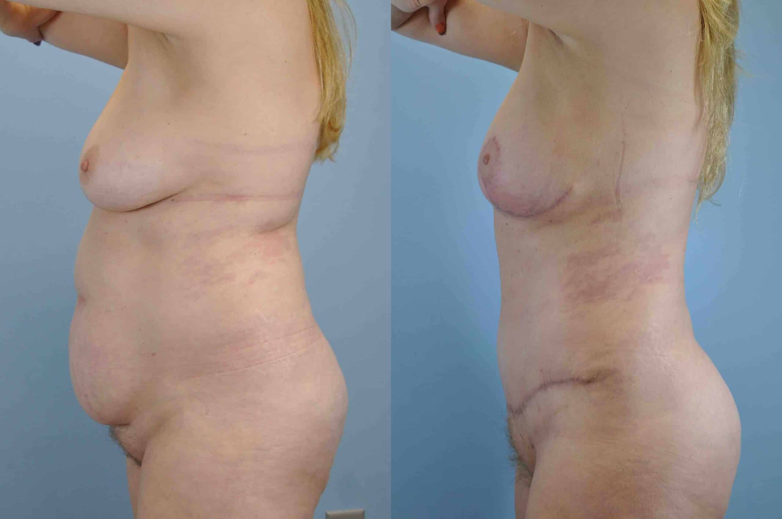 Before and after, 1 yr post op from Tummy Tuck, Breast Lift/Mastopexy, VASER Abdomen Flanks & Back performed by Dr. Paul Vanek (side view)