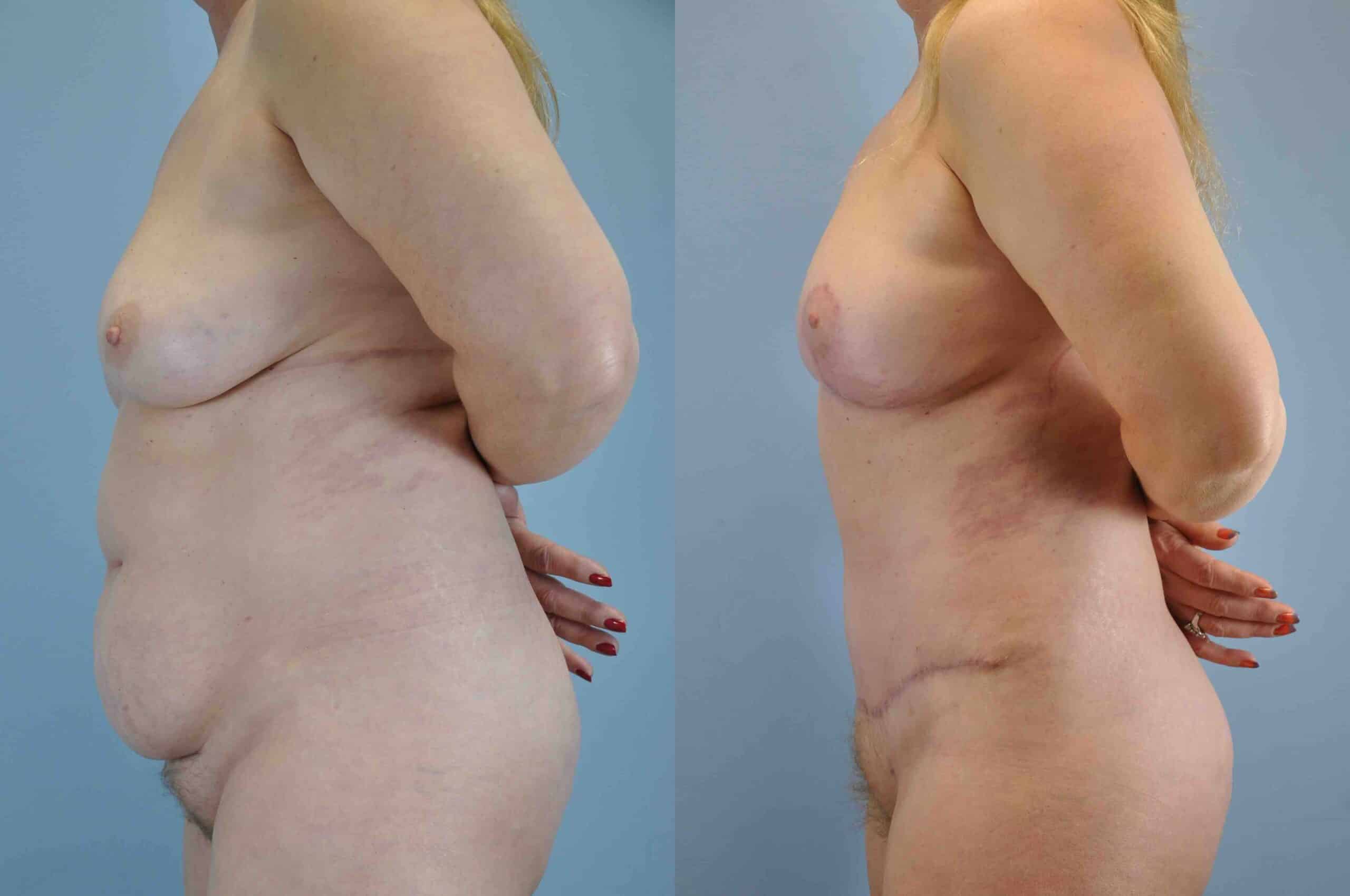 Before and after, 1 yr post op from Tummy Tuck, Breast Lift/Mastopexy, VASER Abdomen Flanks & Back performed by Dr. Paul Vanek (side view)