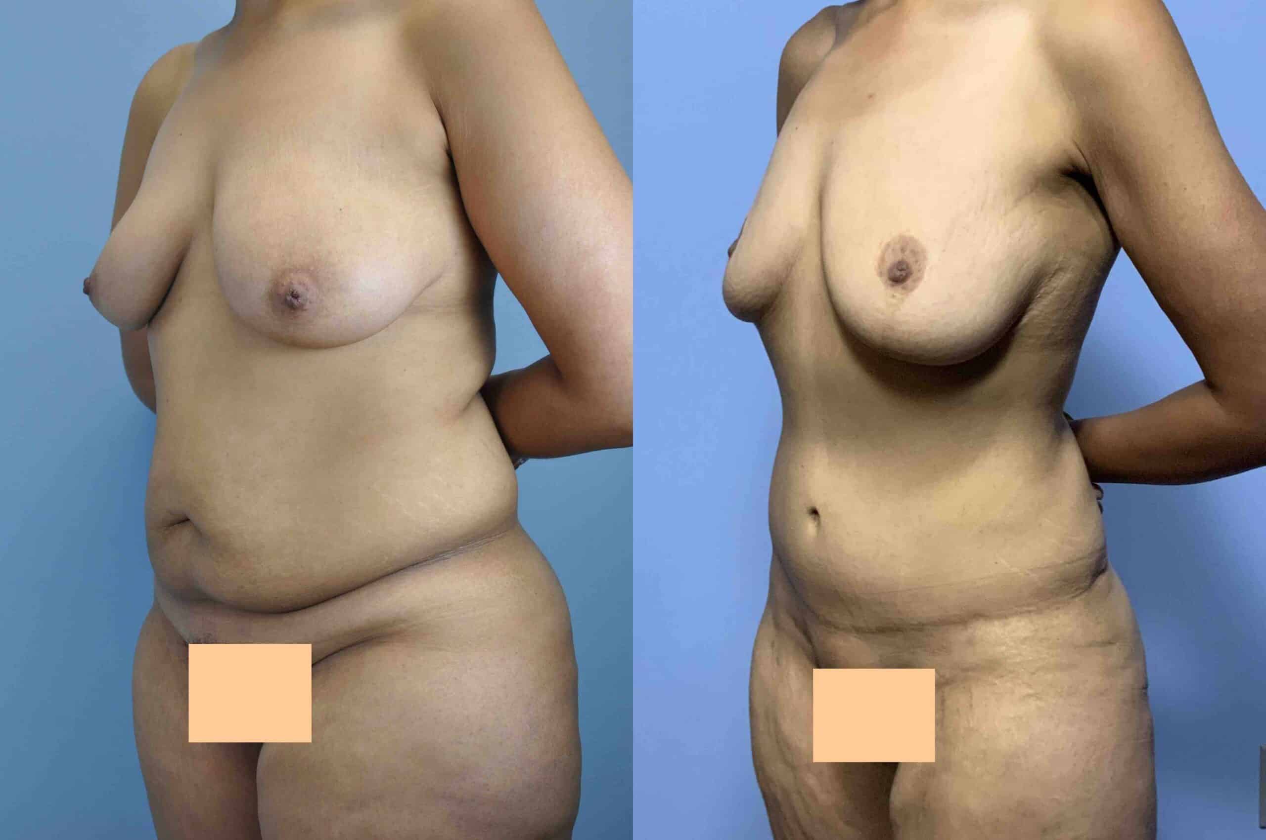 Before and after, 7 yr post op from Tummy Tuck, VASER Abdomen, Flanks, and Back, Mastopexy/Breast Lift performed by Dr. Paul Vanek (diagonal view)