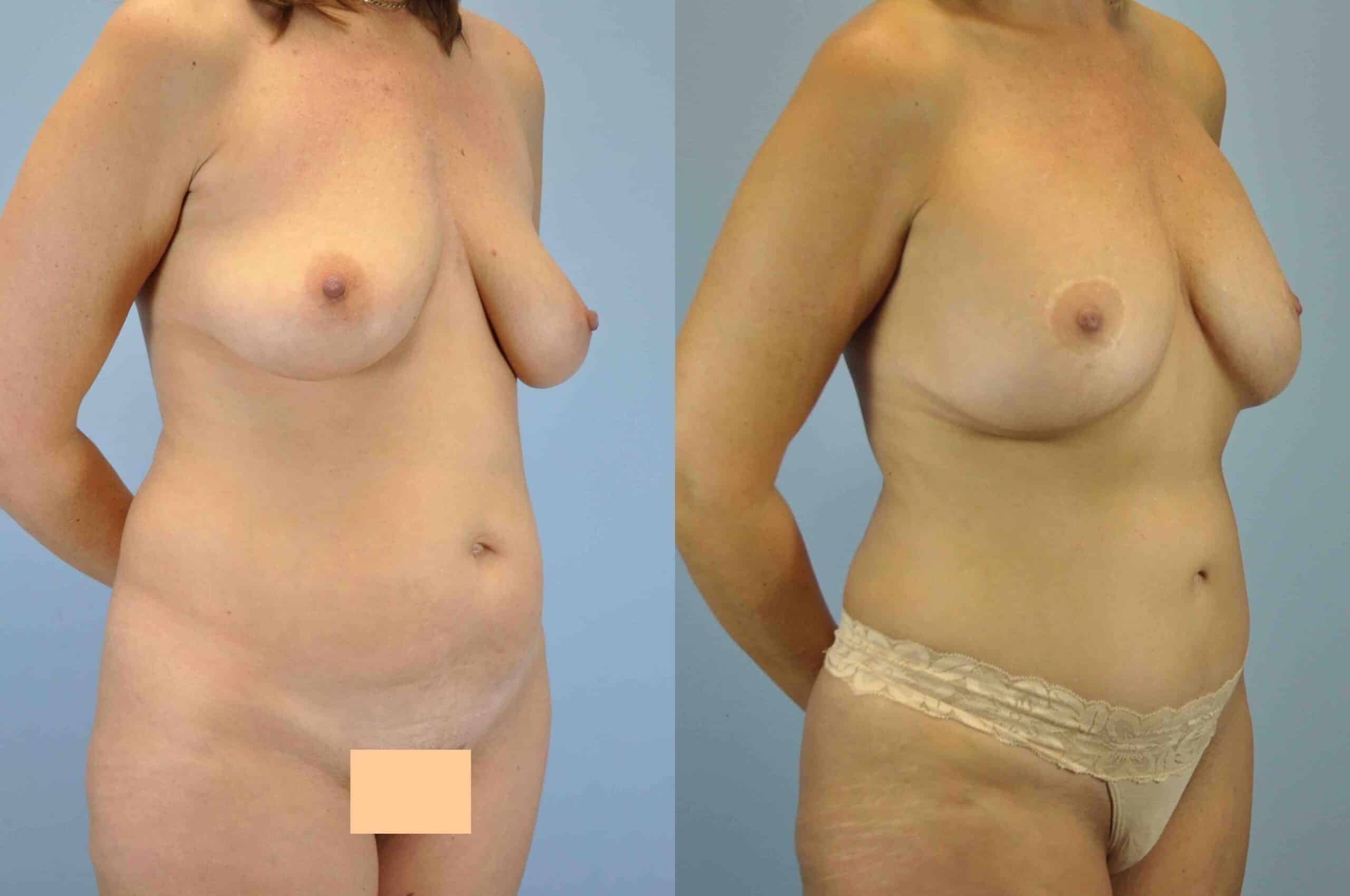Before and after, 5 yr post op from Tummy Tuck, VASER Abdomen, Flanks, and Mons, Mastopexy/Breast Lift, Breast Augmentation performed by Dr. Paul Vanek (diagonal view)