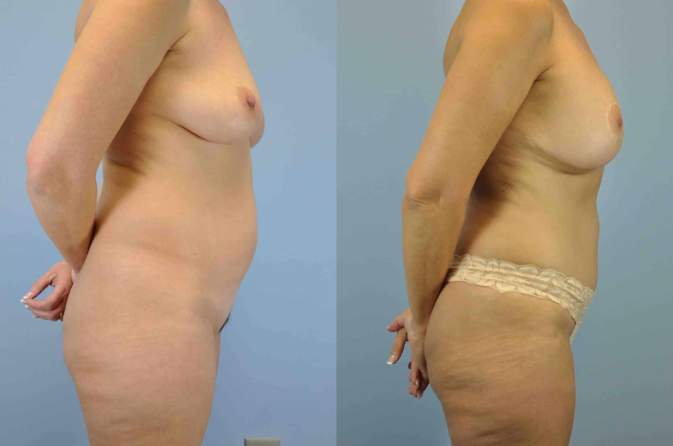 Before and after, 5 yr post op from Tummy Tuck, VASER Abdomen, Flanks, and Mons, Mastopexy/Breast Lift, Breast Augmentation performed by Dr. Paul Vanek (side view)