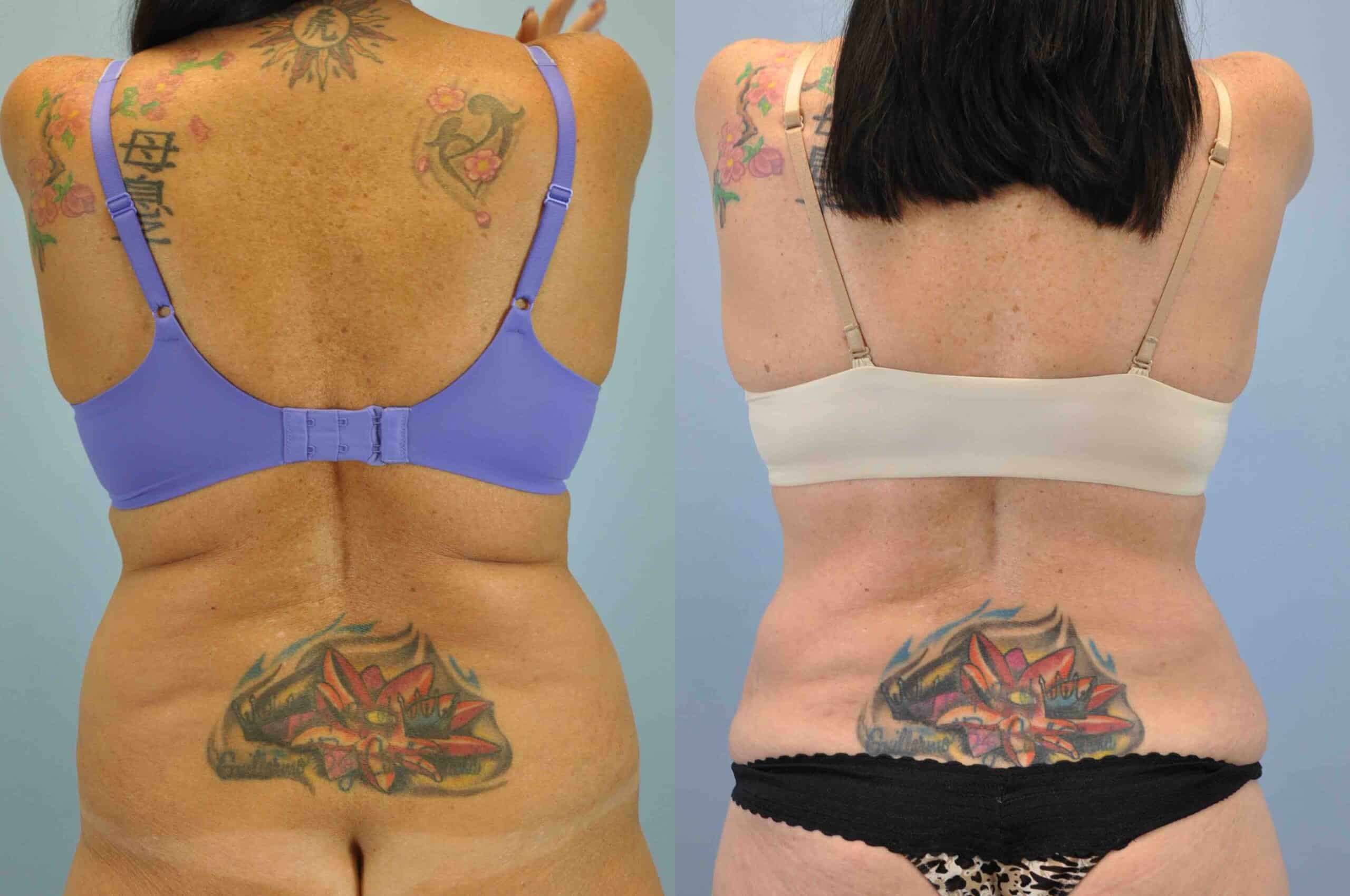 Before and after, 1 yr post op from VASER Abdomen, Flanks, and Back, Panniculectomy performed by Dr. Paul Vanek (rear view)