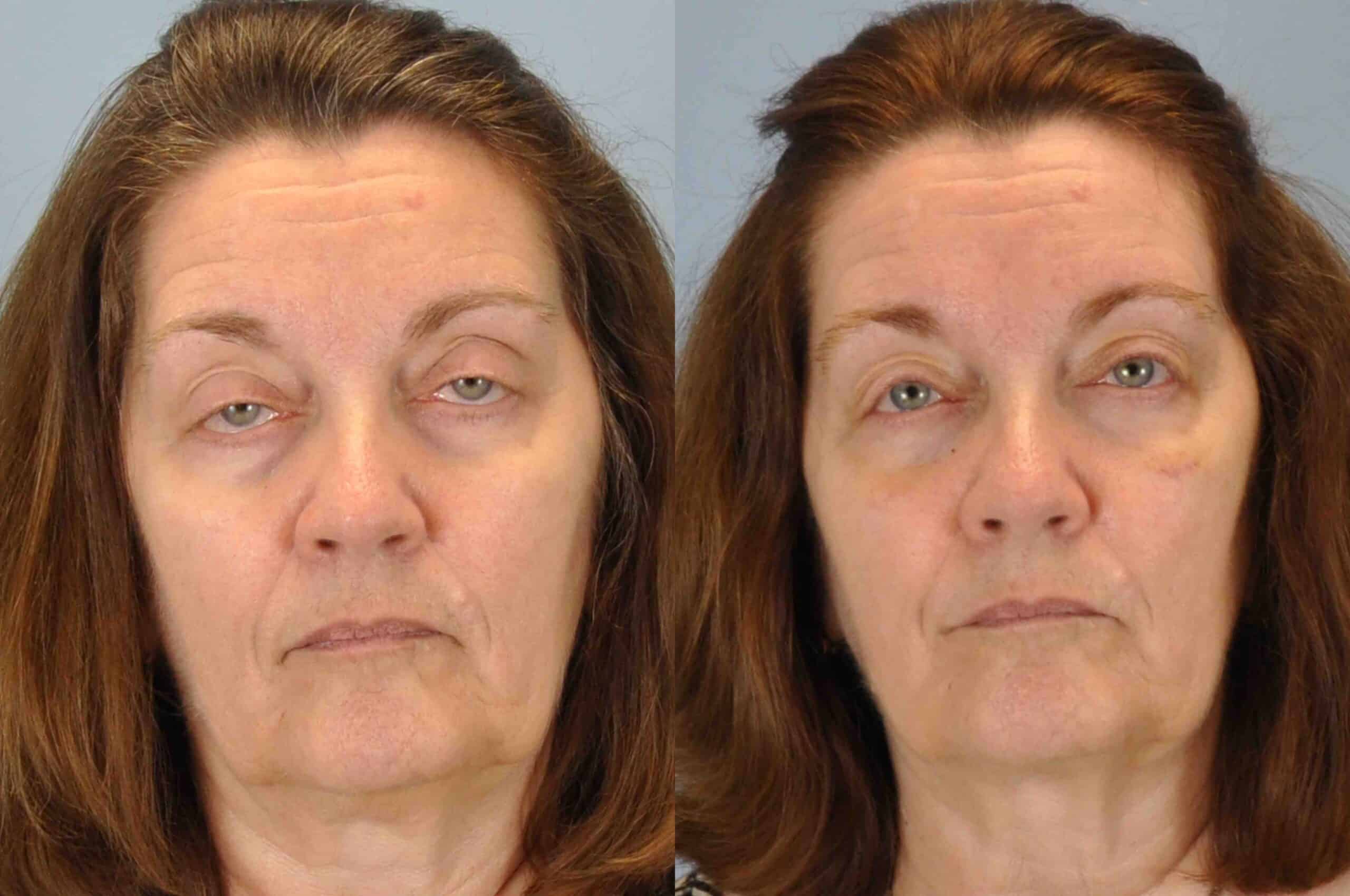 Before and after 3 weeks post op from Lower blepharoplasty, Levator Ptosis performed by Dr. Paul Vanek (front view)