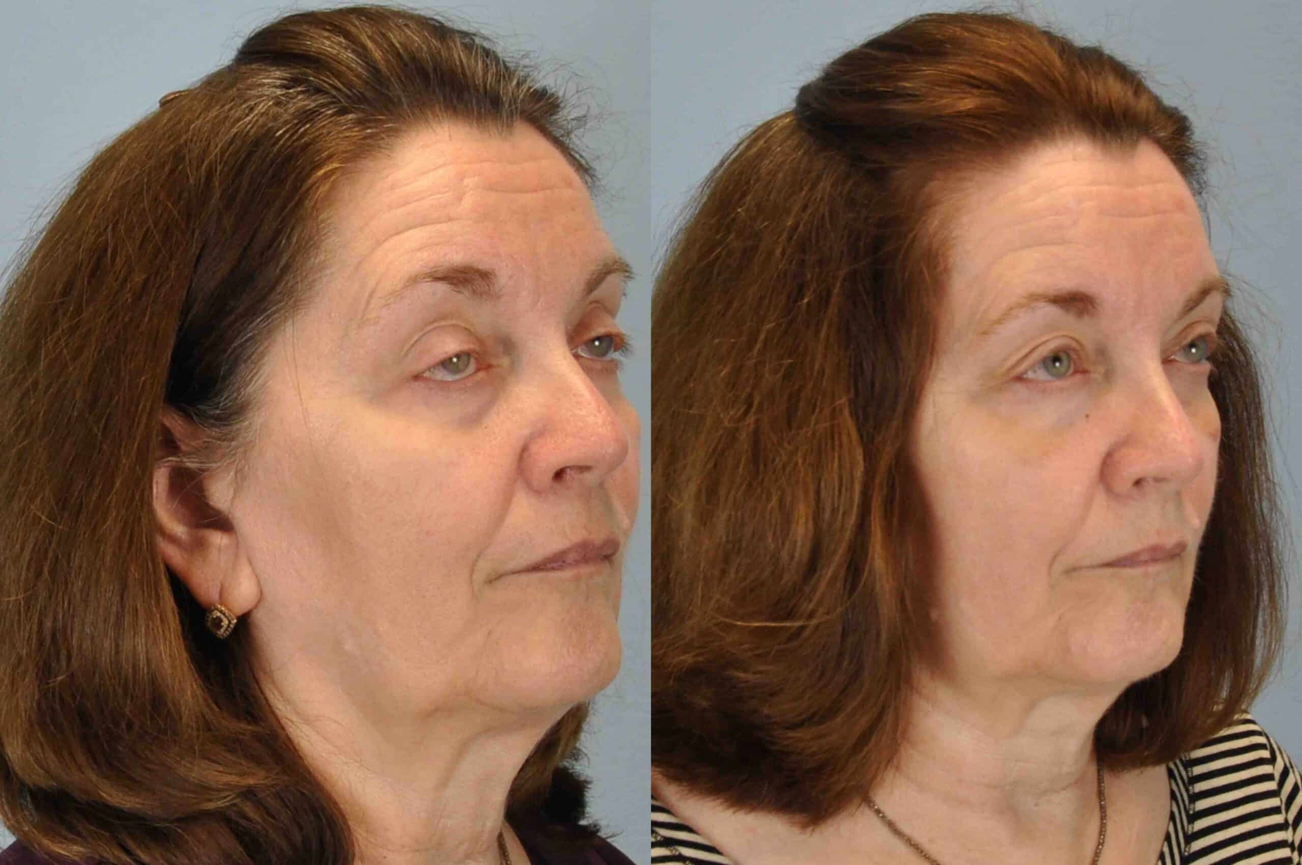 Before and after 3 weeks post op from Lower blepharoplasty, Levator Ptosis performed by Dr. Paul Vanek (diagonal view)