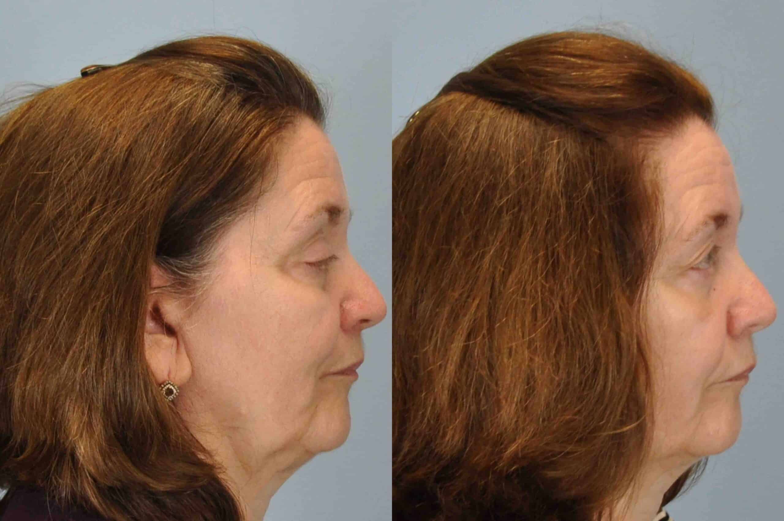 Before and after 3 weeks post op from Lower blepharoplasty, Levator Ptosis performed by Dr. Paul Vanek (side view)