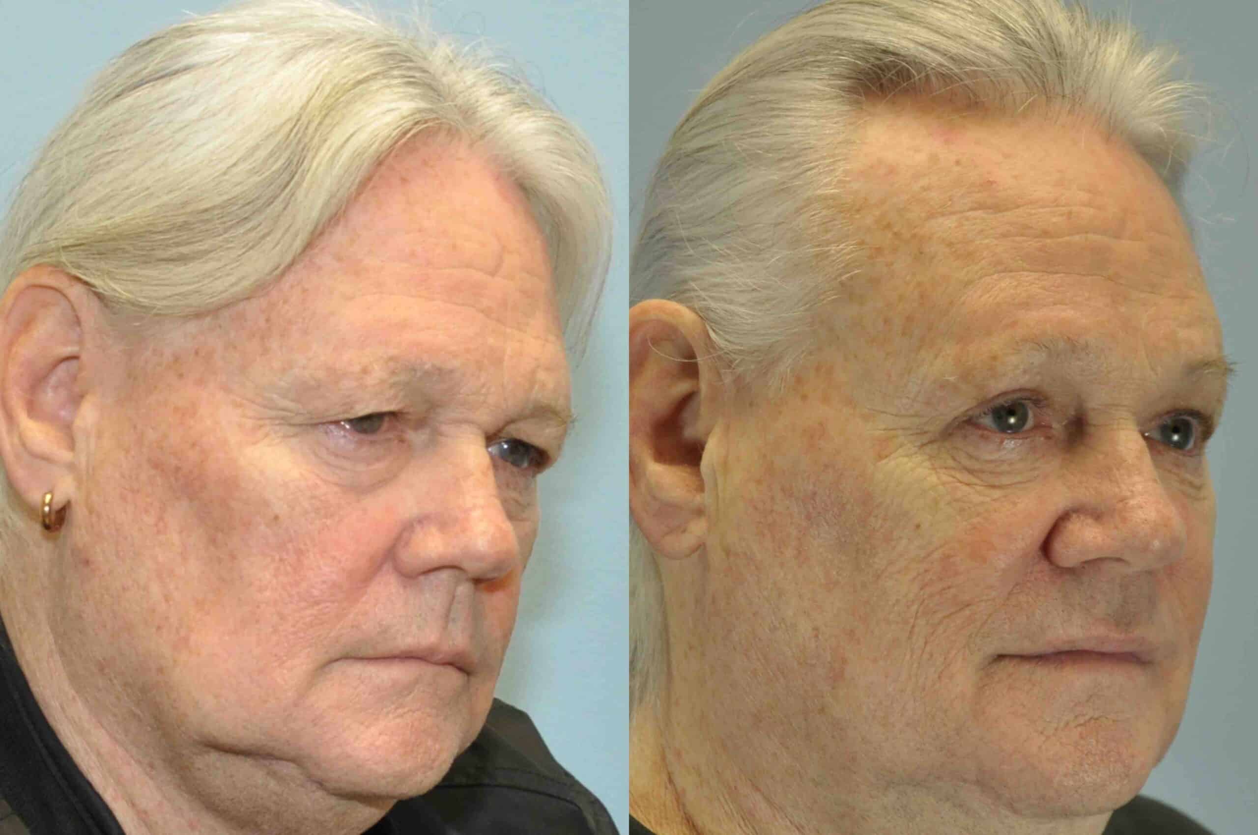 Before and after, 5 mo post op from upper blepharoplasty performed by Dr. Paul Vanek (diagonal view)