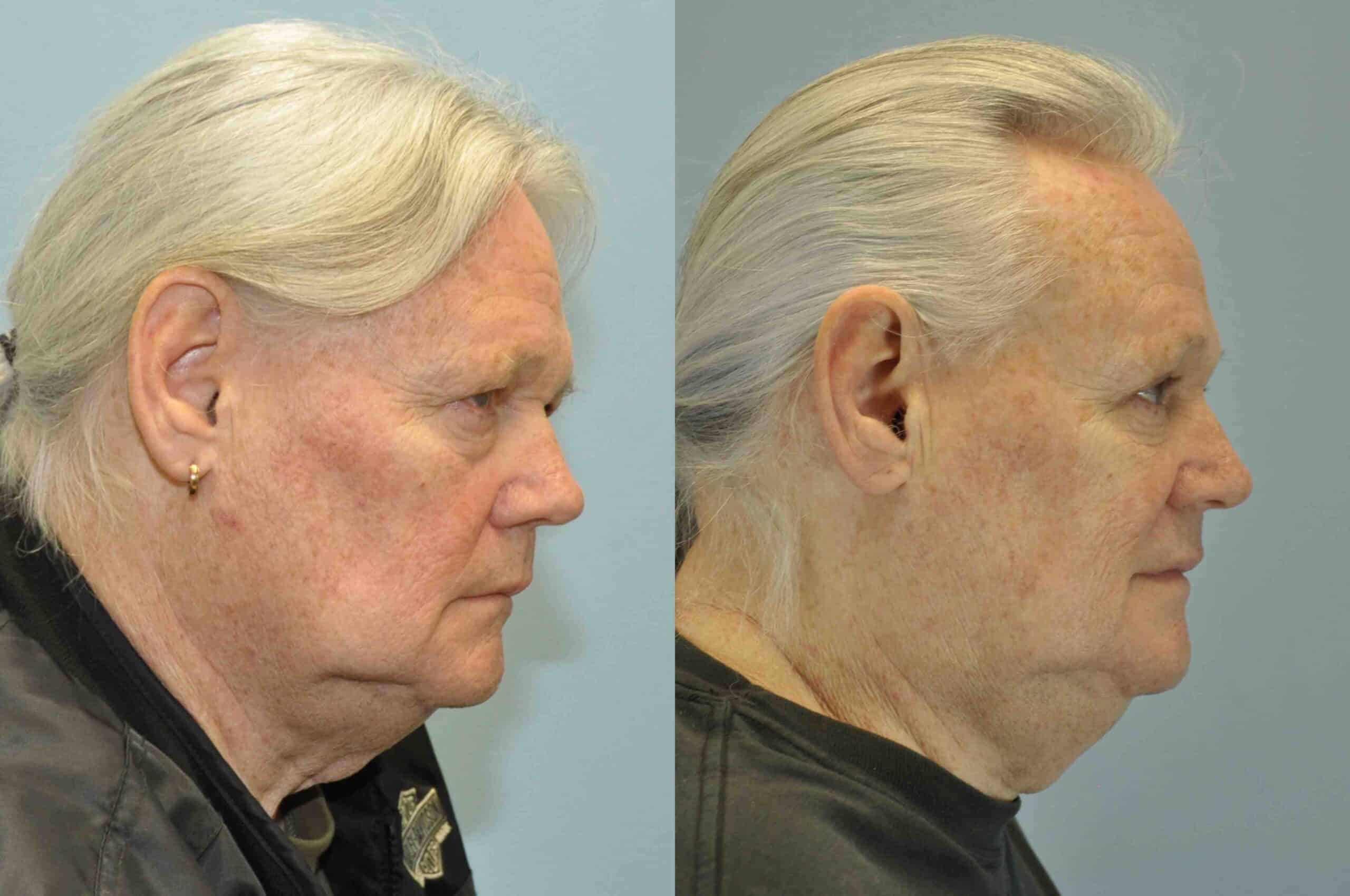Before and after, 5 mo post op from upper blepharoplasty performed by Dr. Paul Vanek (side view)