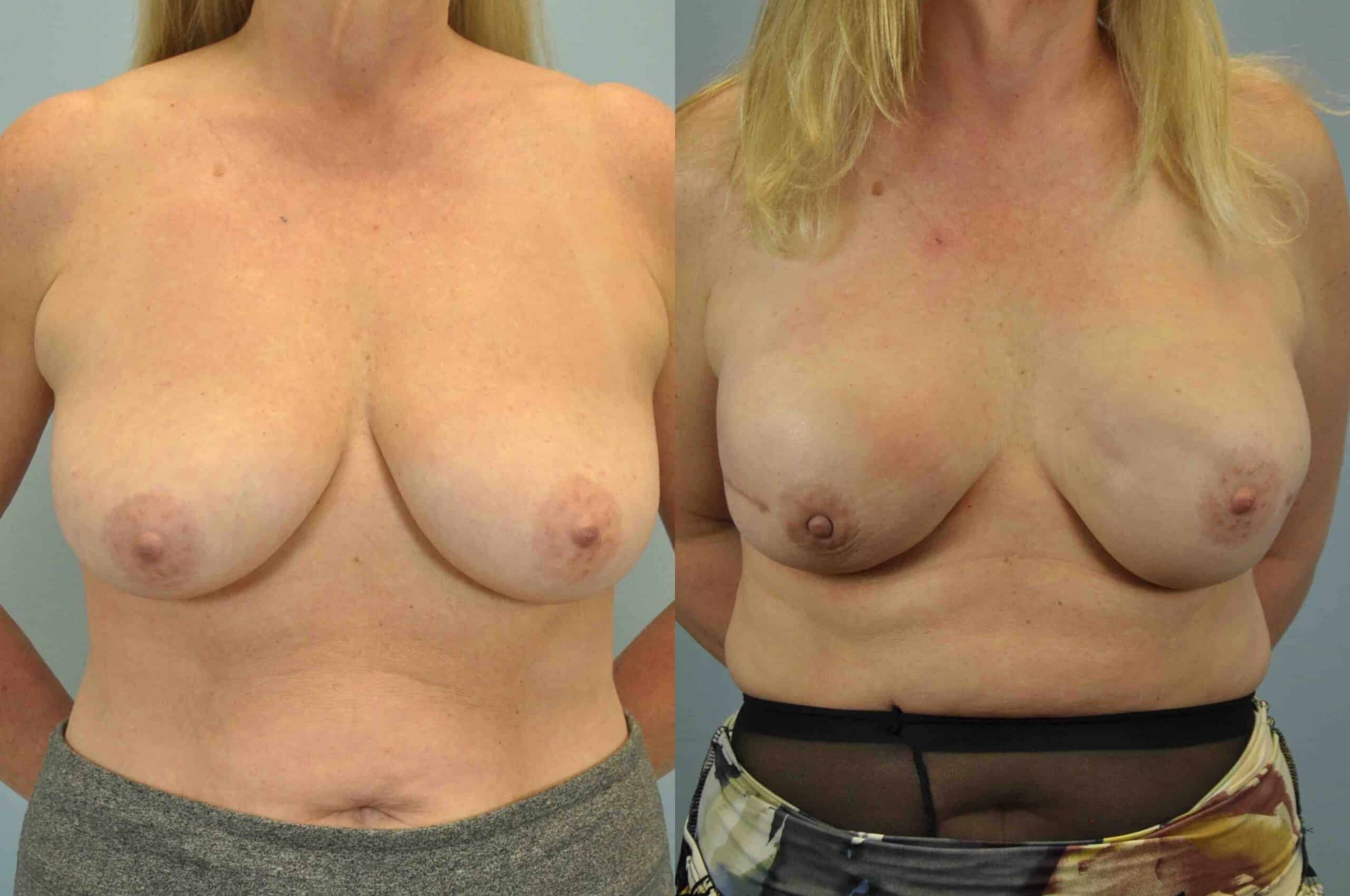 Before and after, 3 mo post op from Single-Stage Breast Reconstruction with Implant, B/L Nipple-Sparing Mastectomy, Alloderm performed by Dr. Paul Vanek (front view)
