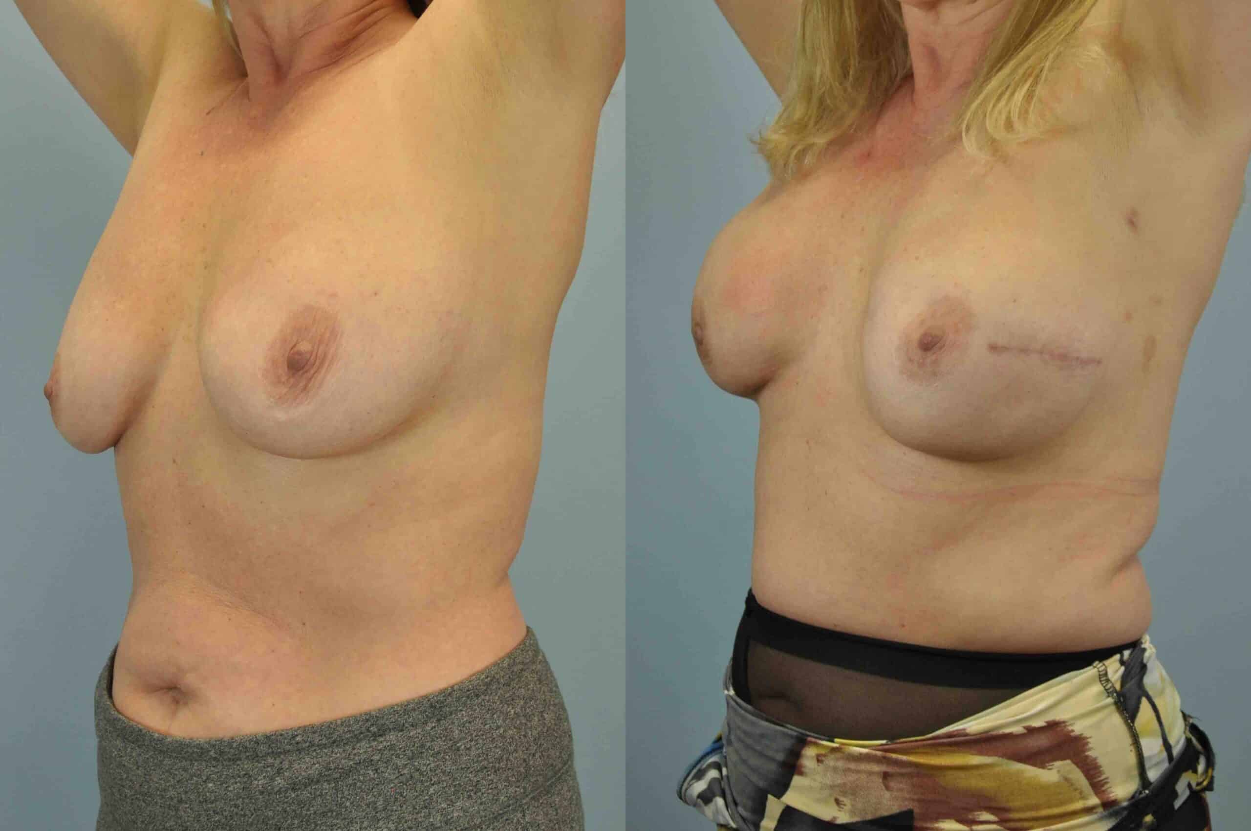 Before and after, 3 mo post op from Single-Stage Breast Reconstruction with Implant, B/L Nipple-Sparing Mastectomy, Alloderm performed by Dr. Paul Vanek (diagonal view)
