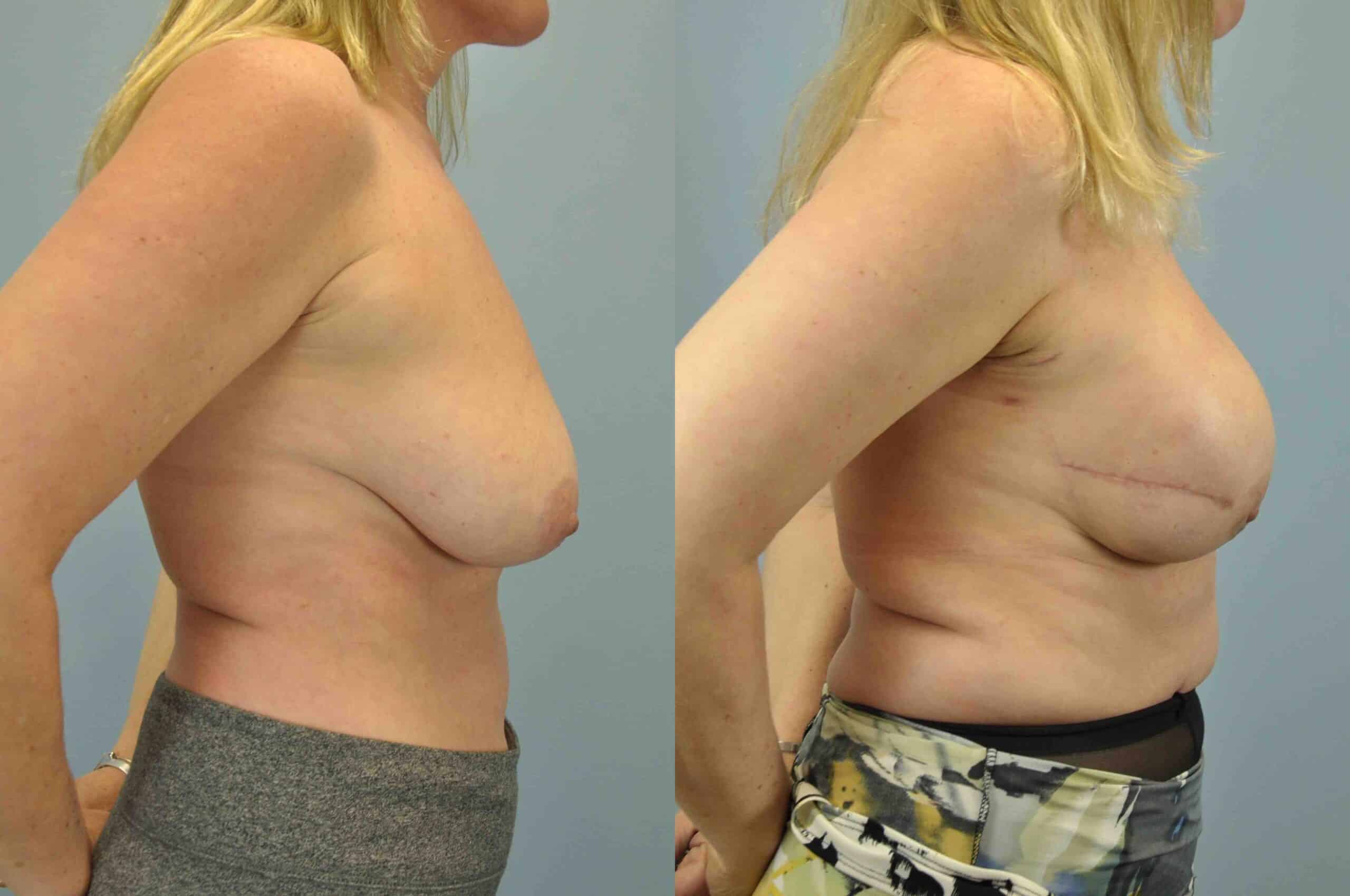 Before and after, 3 mo post op from Single-Stage Breast Reconstruction with Implant, B/L Nipple-Sparing Mastectomy, Alloderm performed by Dr. Paul Vanek (side view)