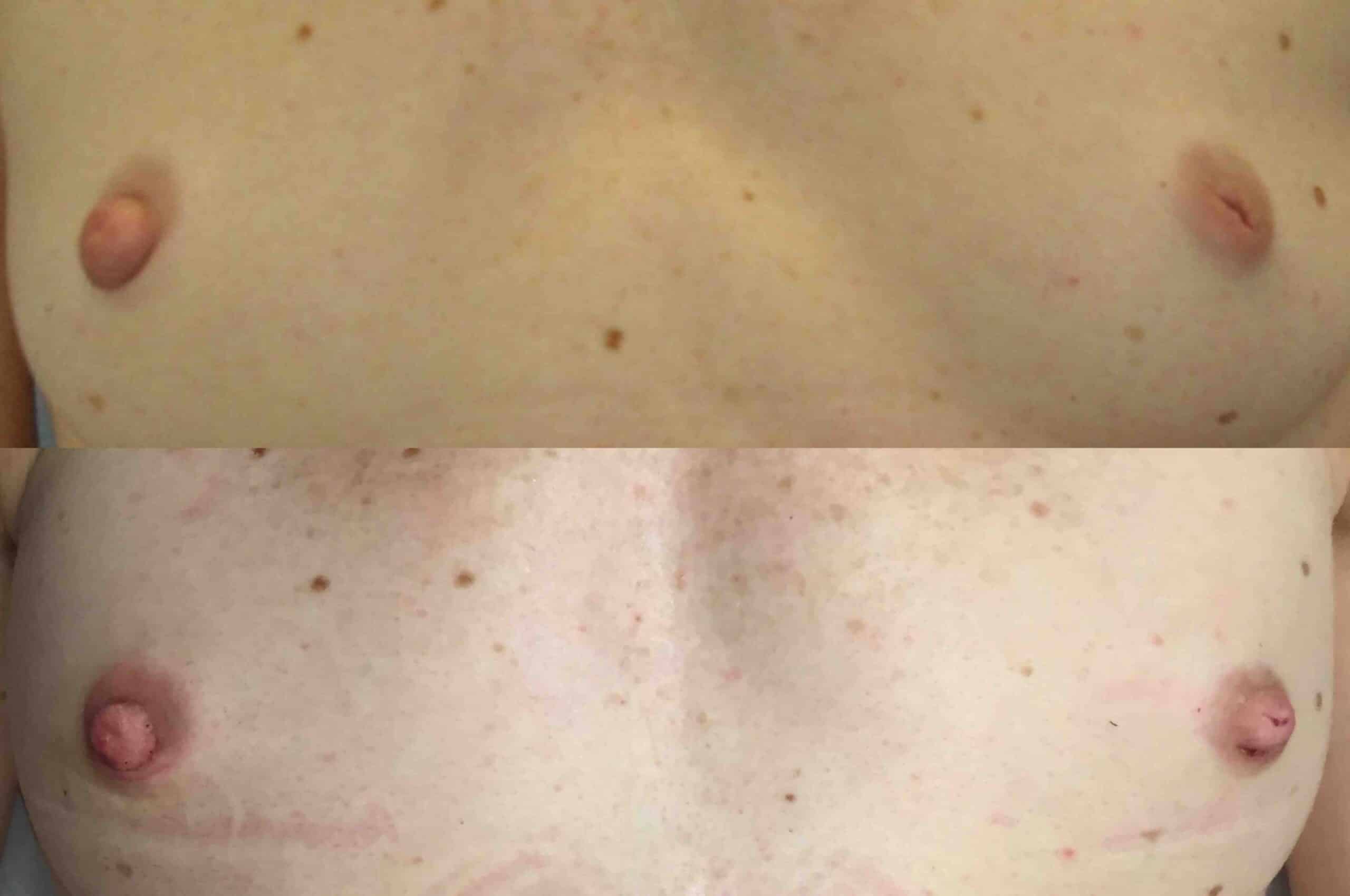 Before and after, 5 mo post op from Inverted Nipple Repair/ Papuloplasty performed by Dr. Paul Vanek (front view)