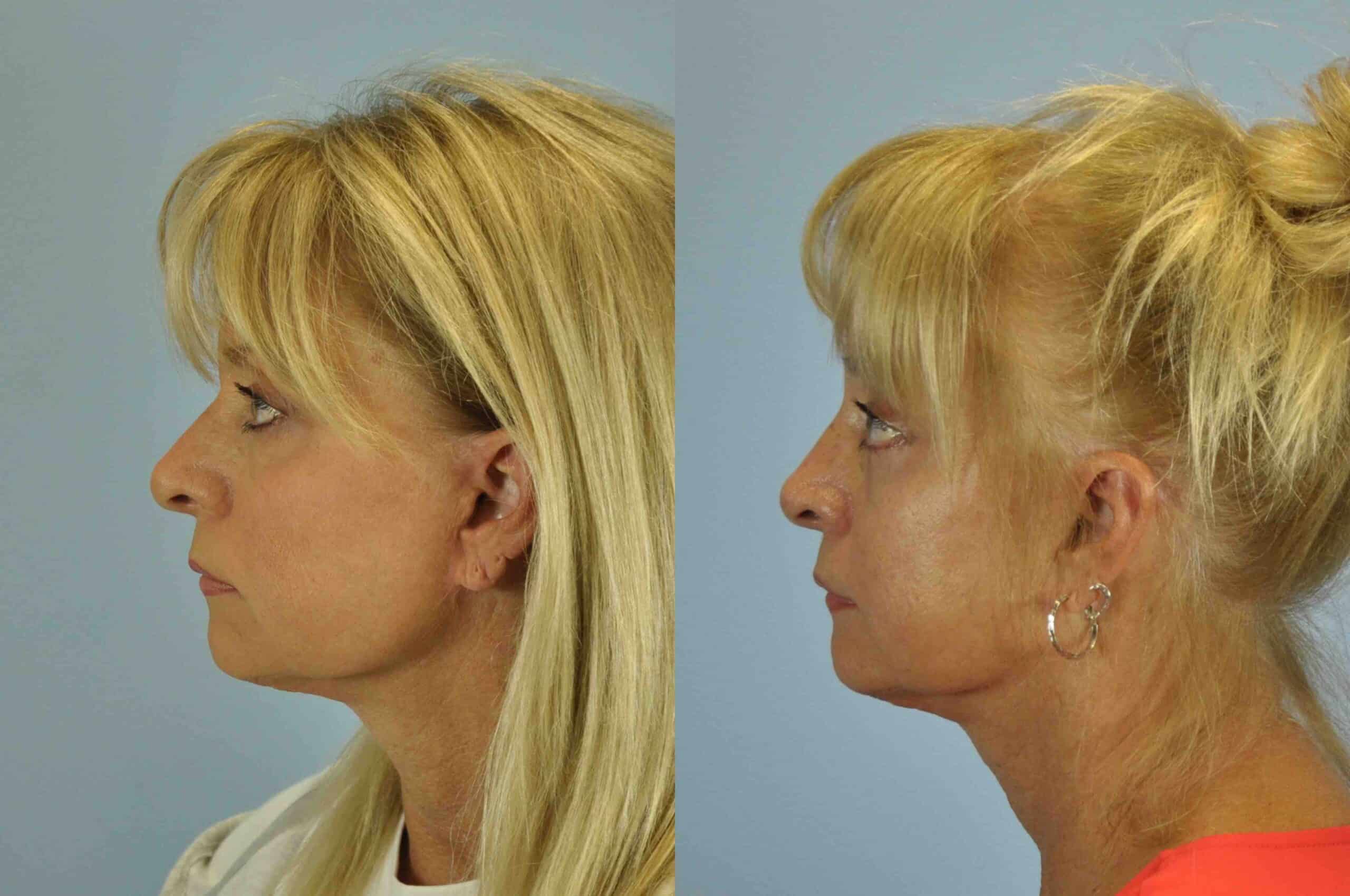 Before and after, 2 mo post op from Lower Blepharoplasty, Canthopexy, Brow Lift performed by Dr. Paul Vanek (side view)