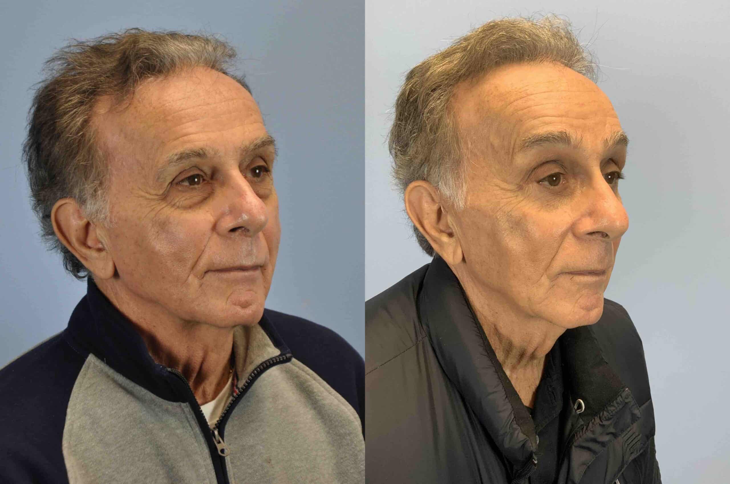 Before and after, 8 mo post op after Upper and Lower Blepharoplasty, Endo Brow Lift performed by Dr. Paul Vanek (diagonal view)