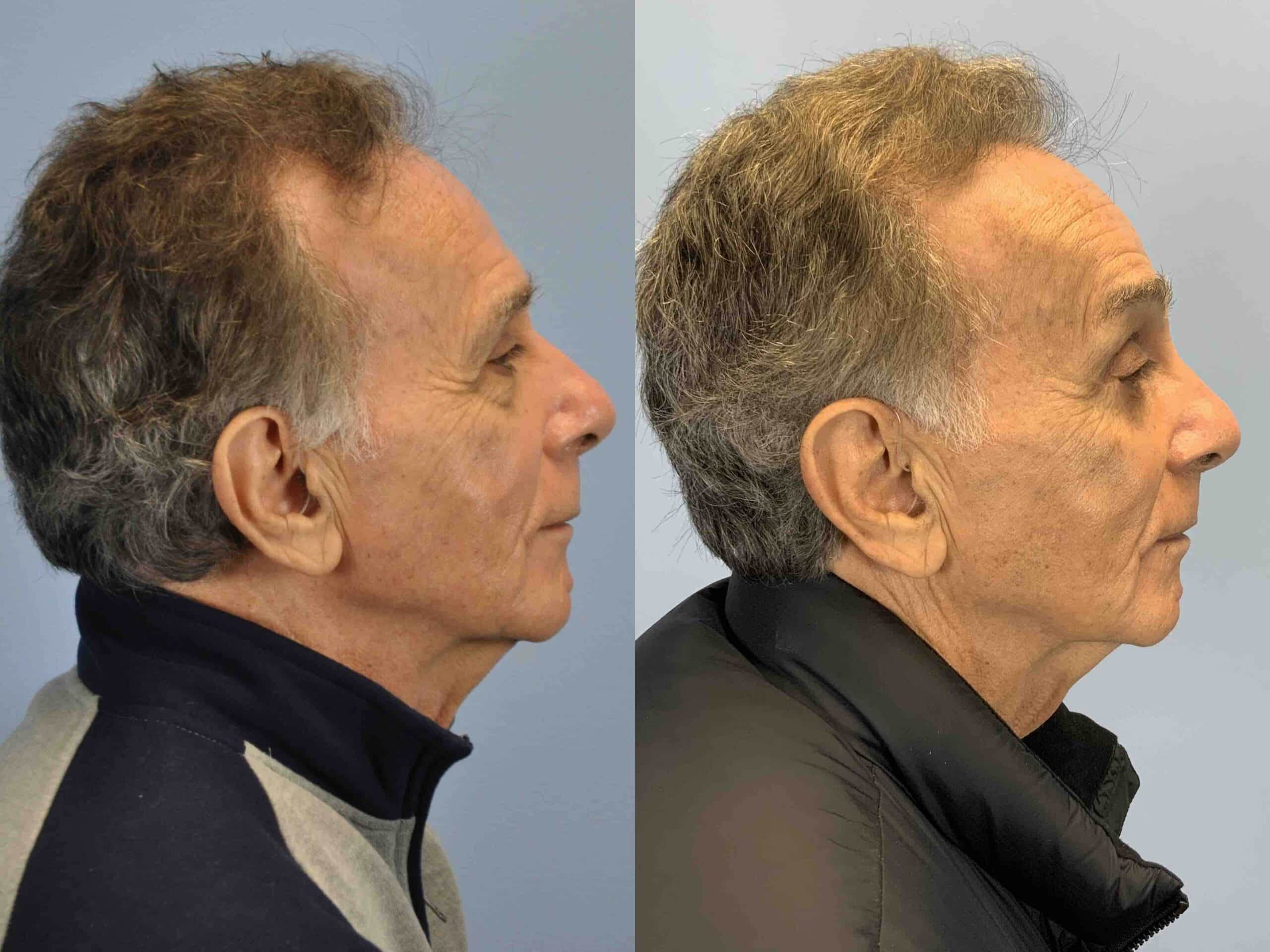 Before and after, 8 mo post op after Upper and Lower Blepharoplasty, Endo Brow Lift performed by Dr. Paul Vanek (side view)