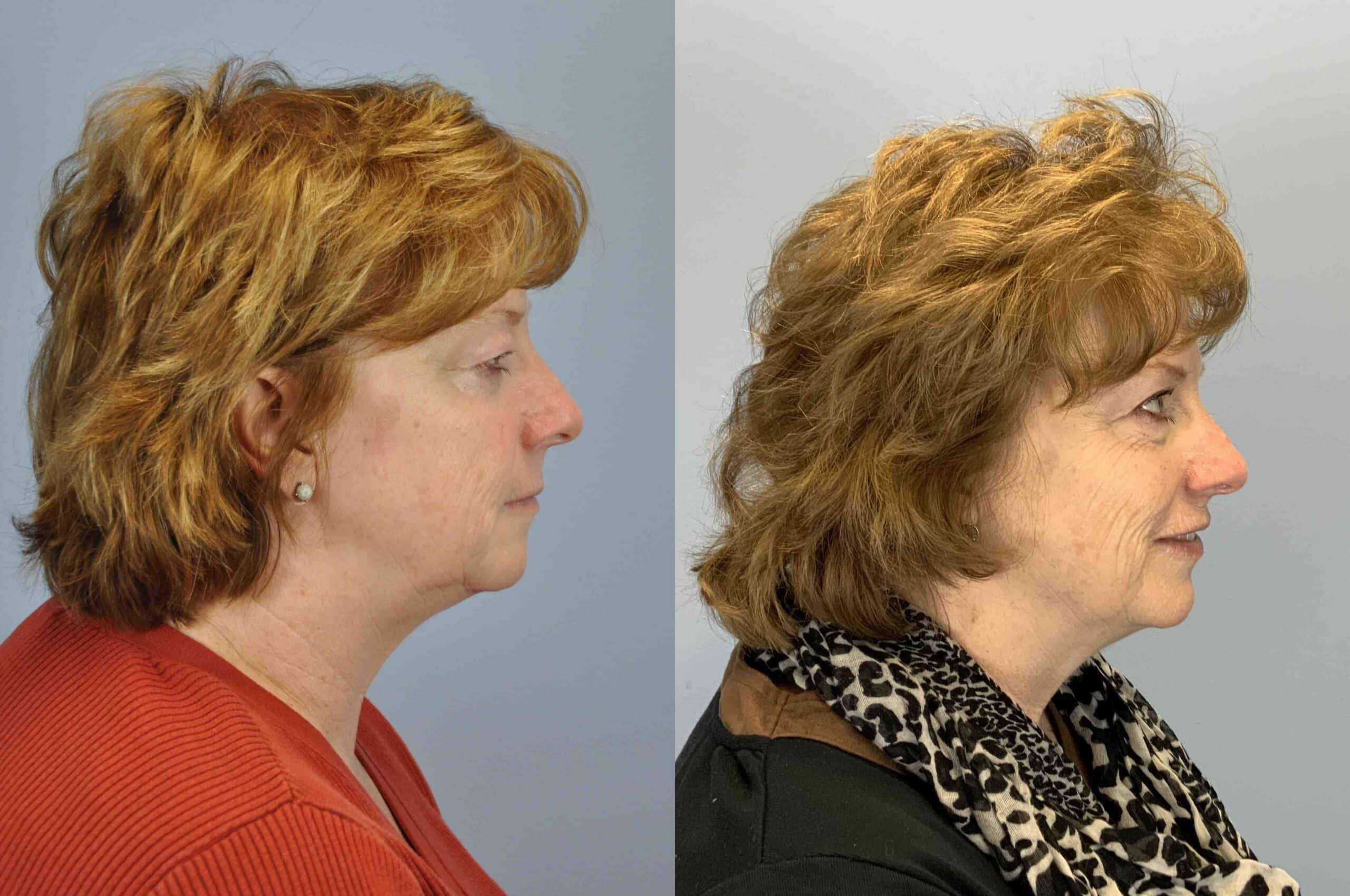 Before and after, 6 mo post op from Upper Blepharoplasty, Levator Ptosis (side view)