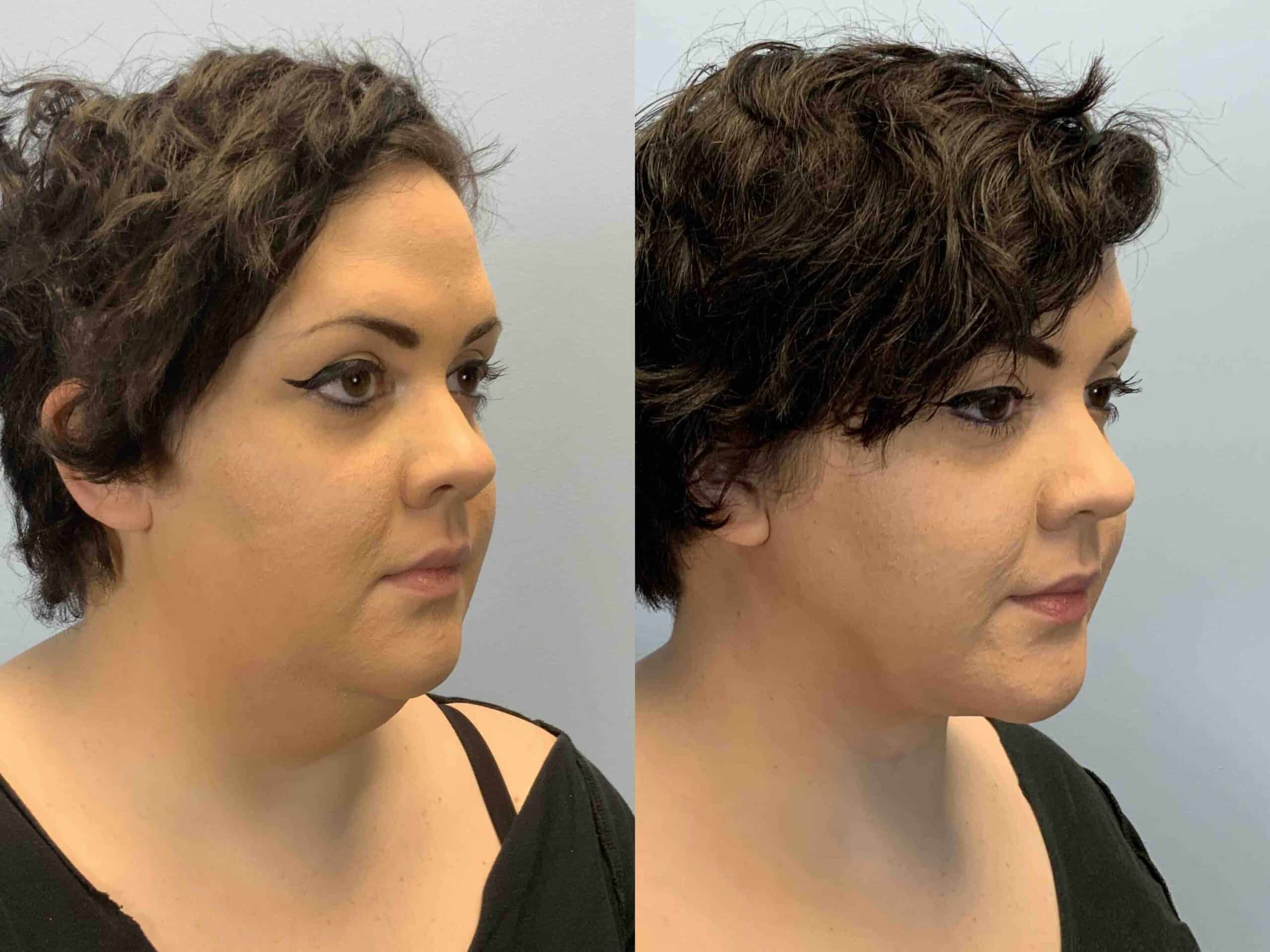 Before and after, 2 mo post op from Neck Lift performed by Dr. Paul Vanek (diagonal view)
