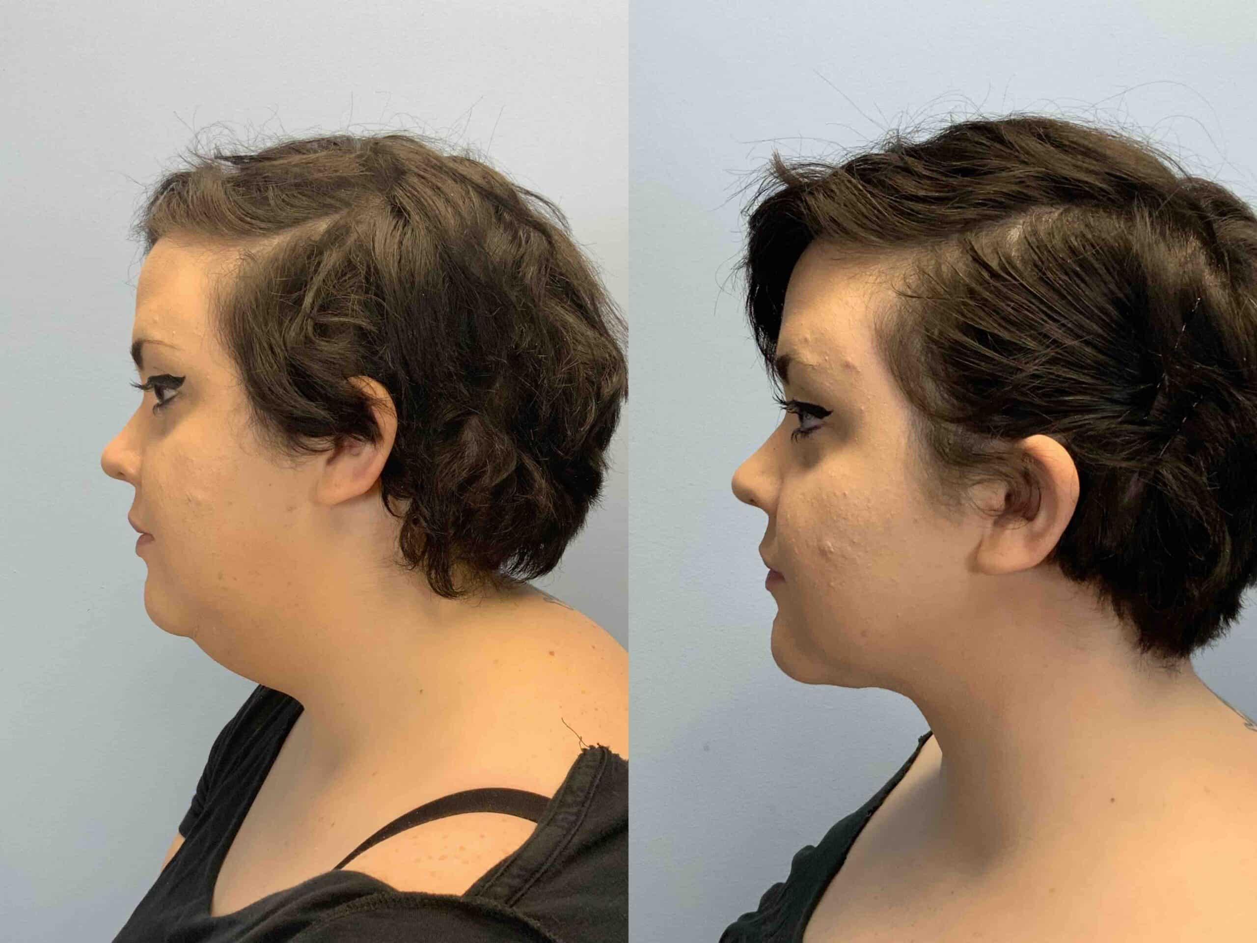 Before and after, 2 mo post op from Neck Lift performed by Dr. Paul Vanek (side view)