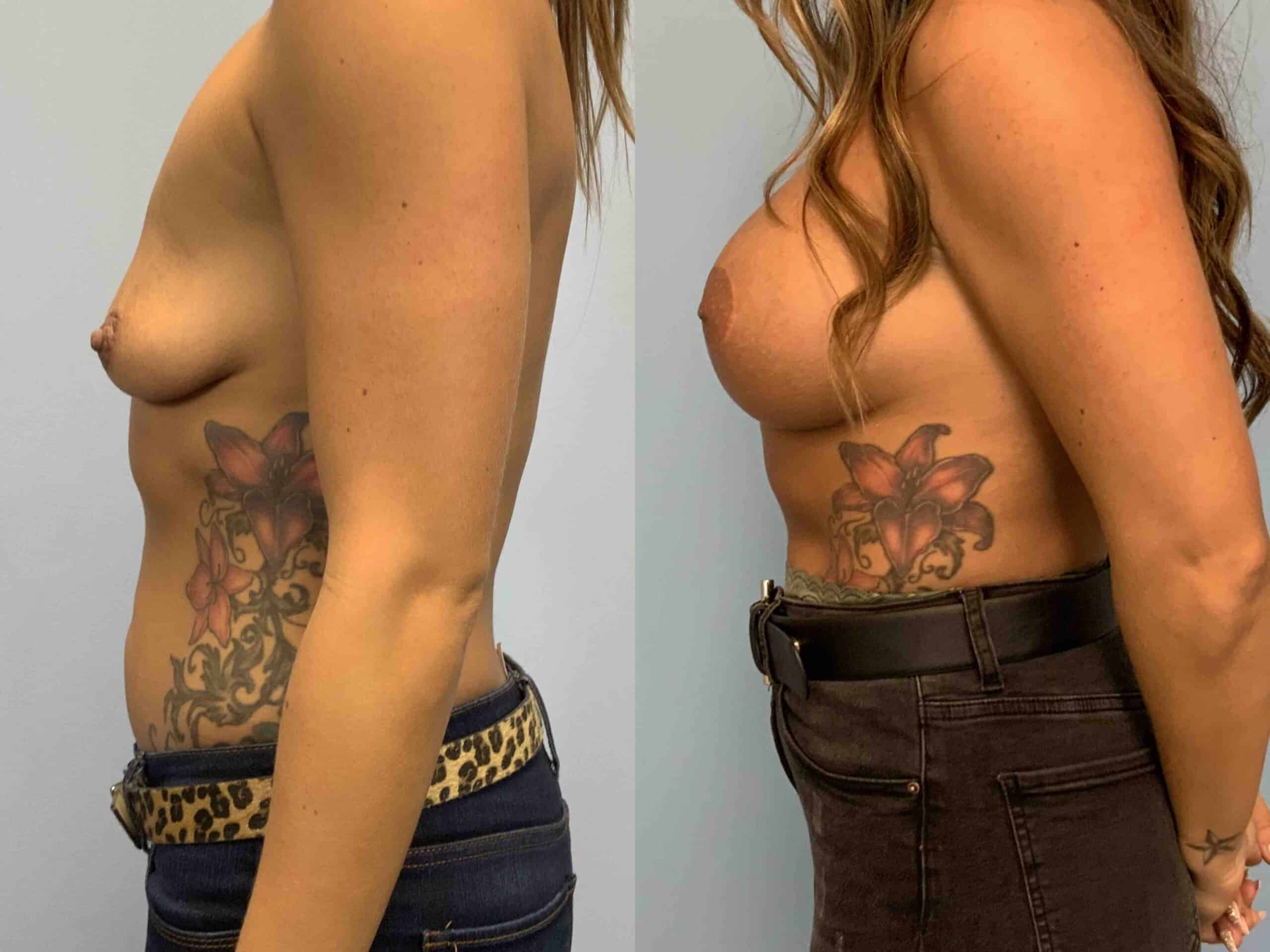Before and after, 1 yr post op from Breast Augmentation with Breast Lift/Wise pattern Mastopexy performed by Dr. Paul Vanek (side view)