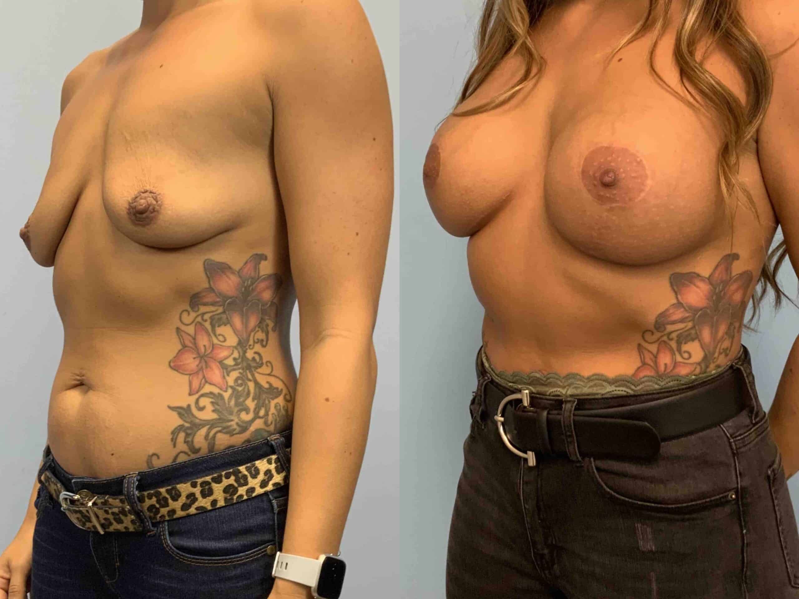 Before and after, 1 yr post op