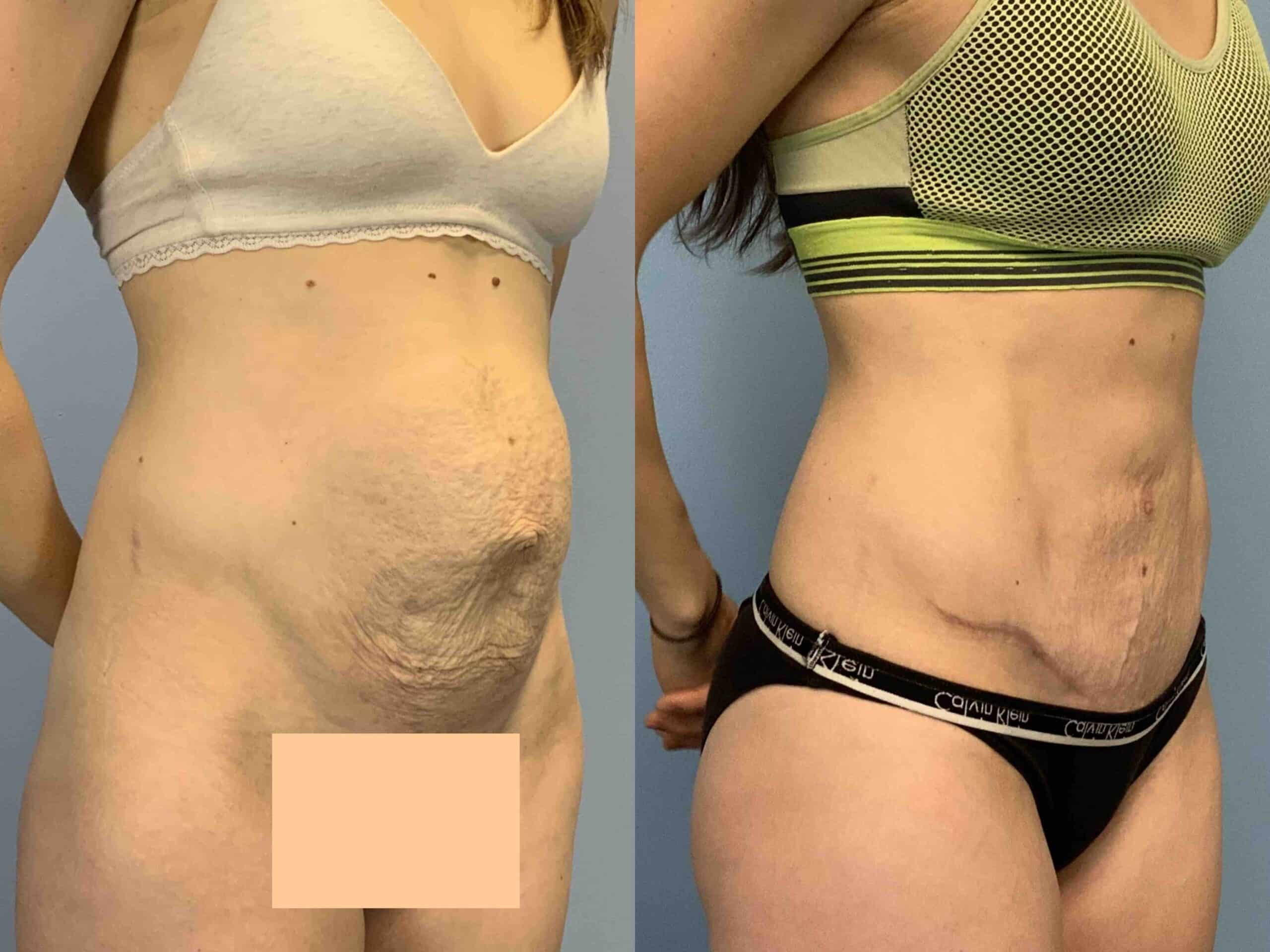 Before and after, 6 mo post op from Abdominoplasty, Hernia Repair Surgery performed by Dr. Paul Vanek (diagonal view)