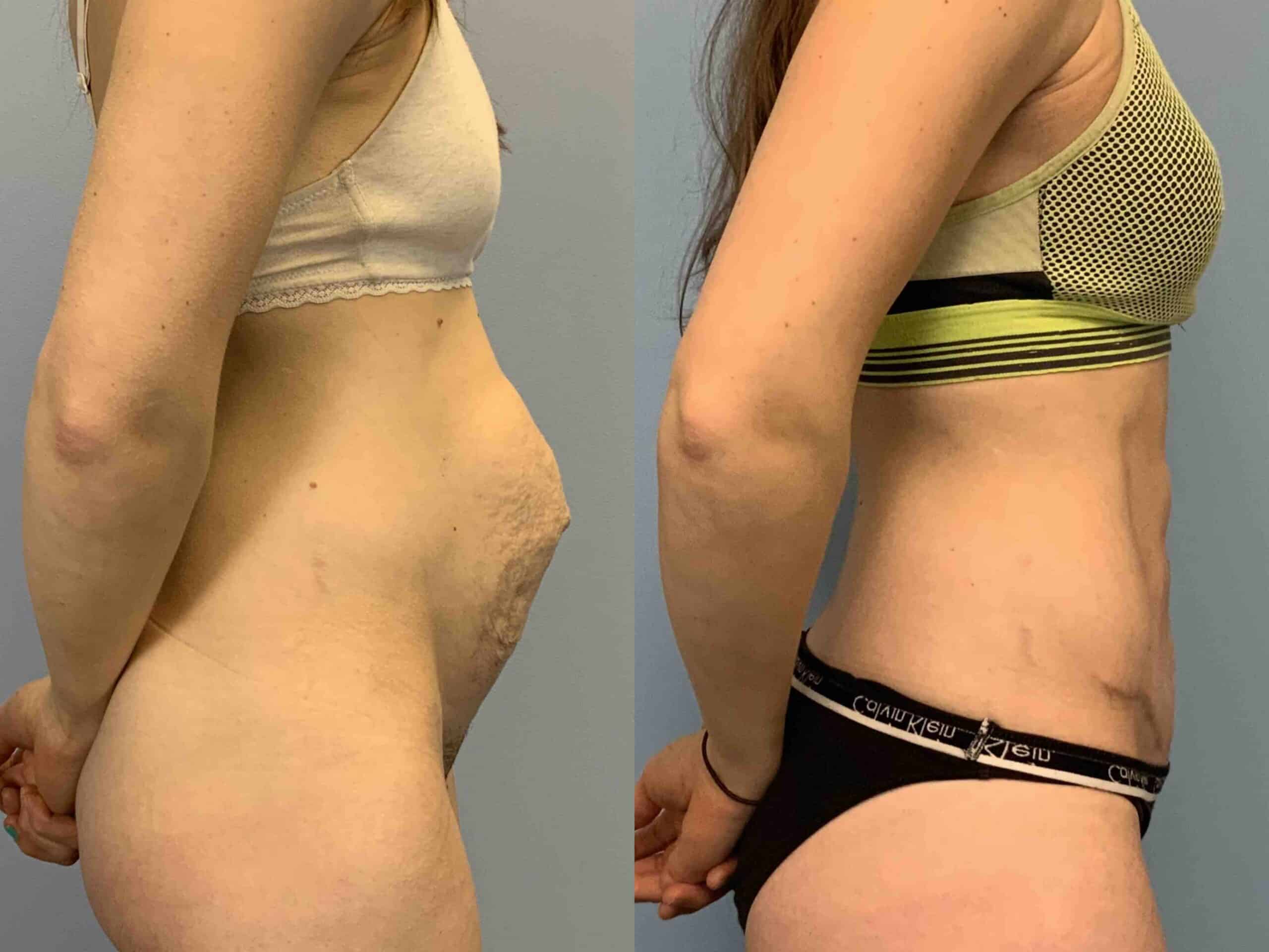 Before and after, 6 mo post op from Abdominoplasty, Hernia Repair Surgery performed by Dr. Paul Vanek (side view)