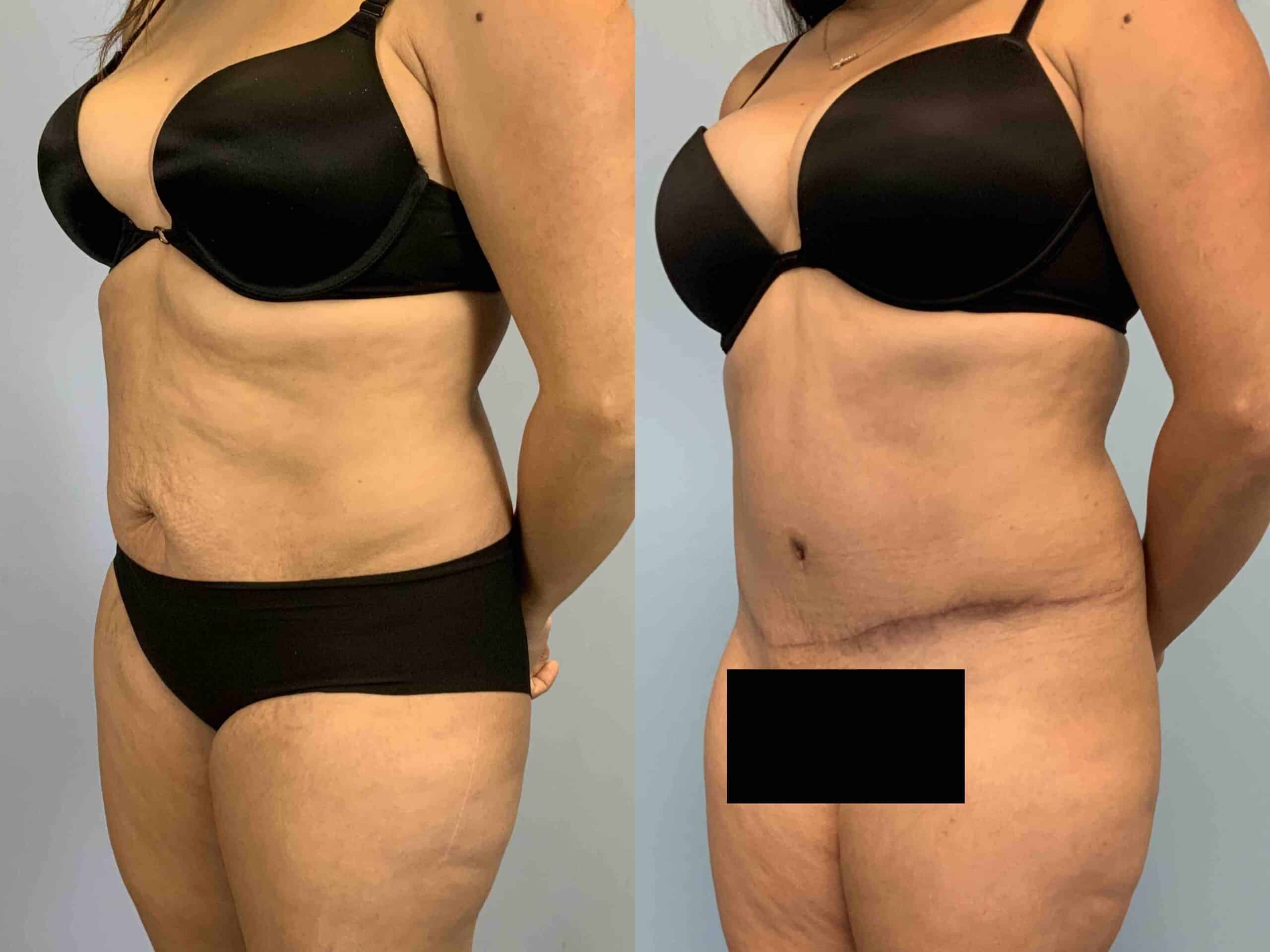 Before and after, 2 mo post op from tummy tuck performed by Dr. Paul Vanek (diagonal view)