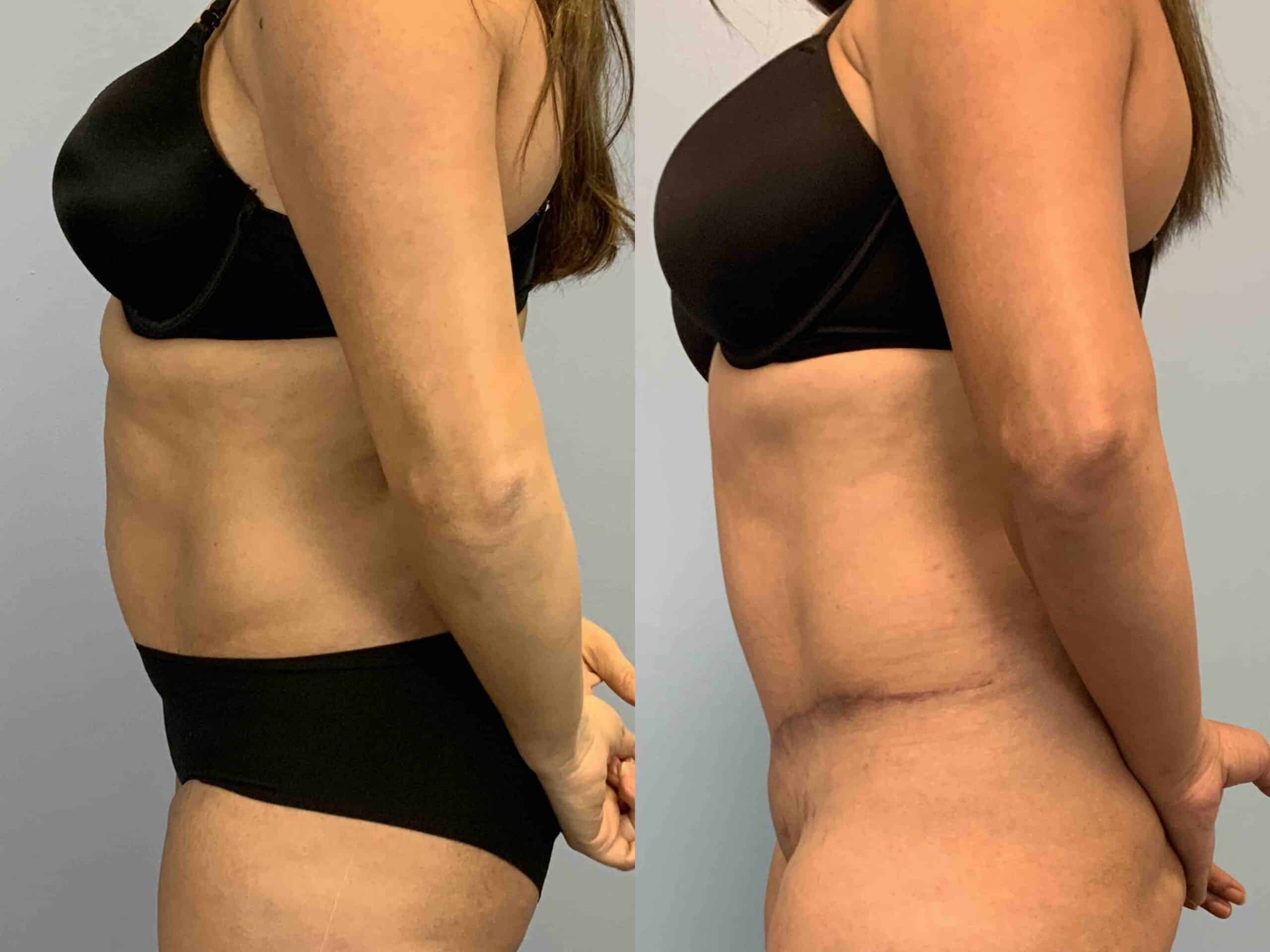 Before and after, 2 mo post op from tummy tuck performed by Dr. Paul Vanek (side view)