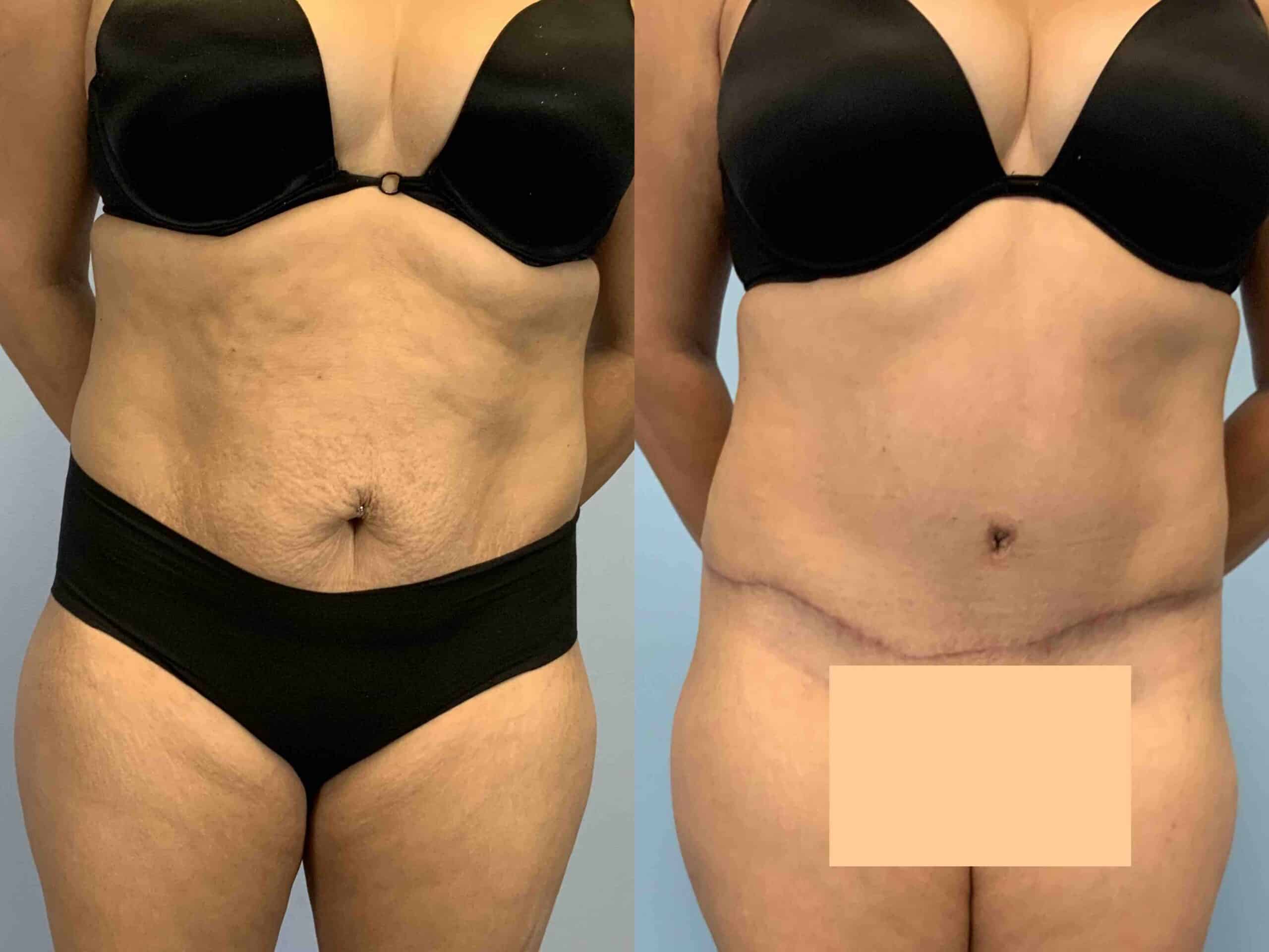 Before and after, 2 mo post op from tummy tuck performed by Dr. Paul Vanek (front view)