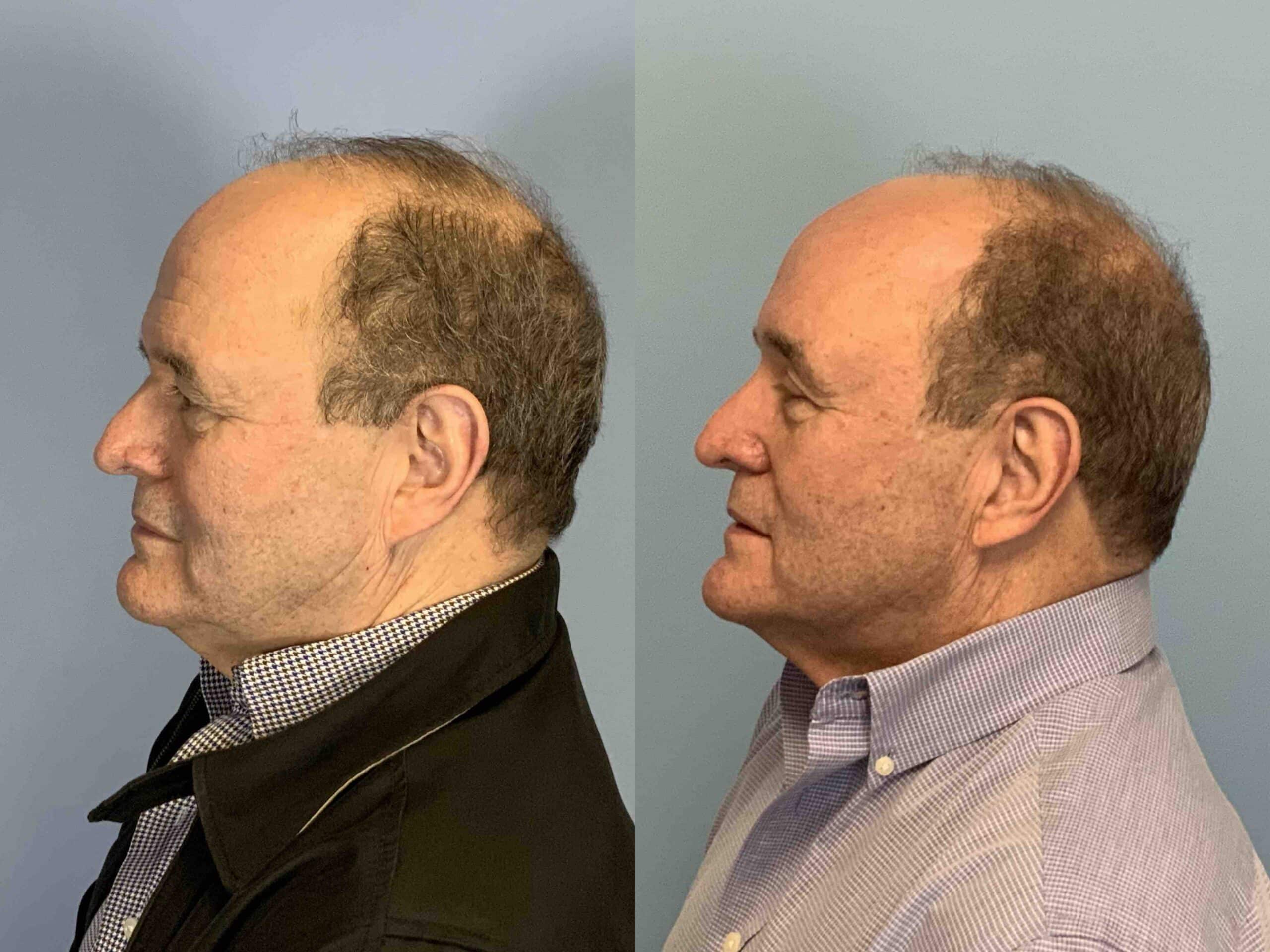 Before and after, 4 mo post op from Endo Brow Lift, Upper Blepharoplasty performed by Dr. Paul Vanek (side view)