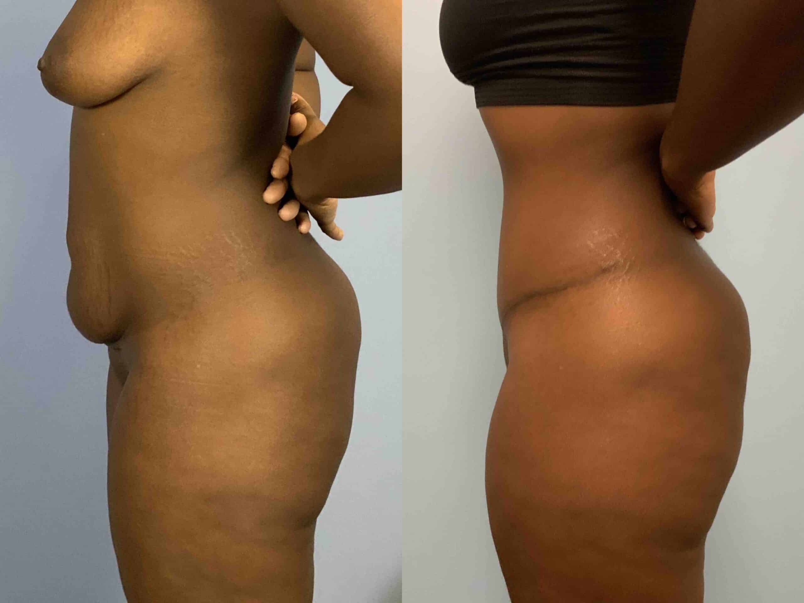 Before and after, 1 year post op from Tummy Tuck performed by Dr. Paul Vanek (side view)