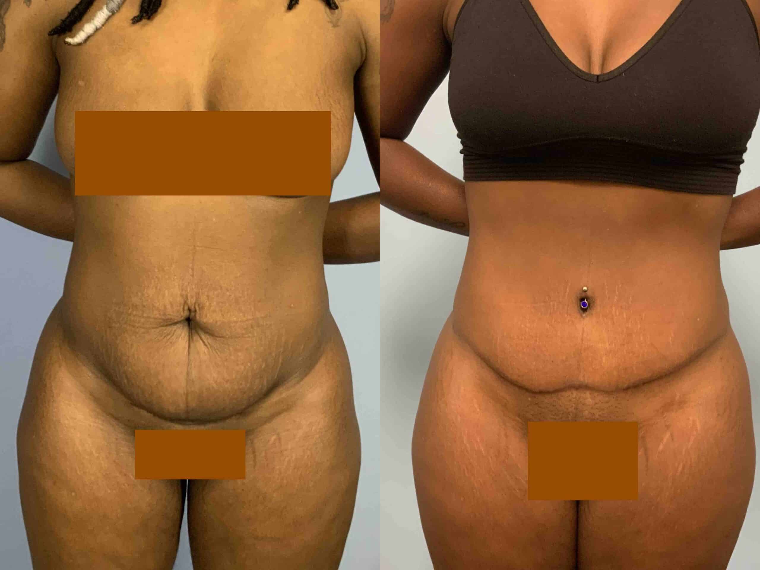 Before and after, 1 year post op from Tummy Tuck performed by Dr. Paul Vanek (front view)