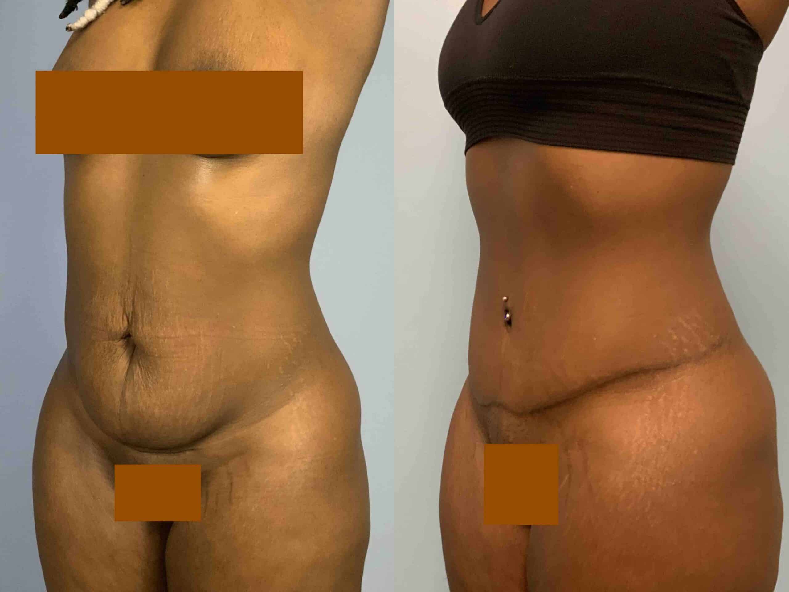 Before and after, 1 year post op from Tummy Tuck performed by Dr. Paul Vanek (diagonal view)