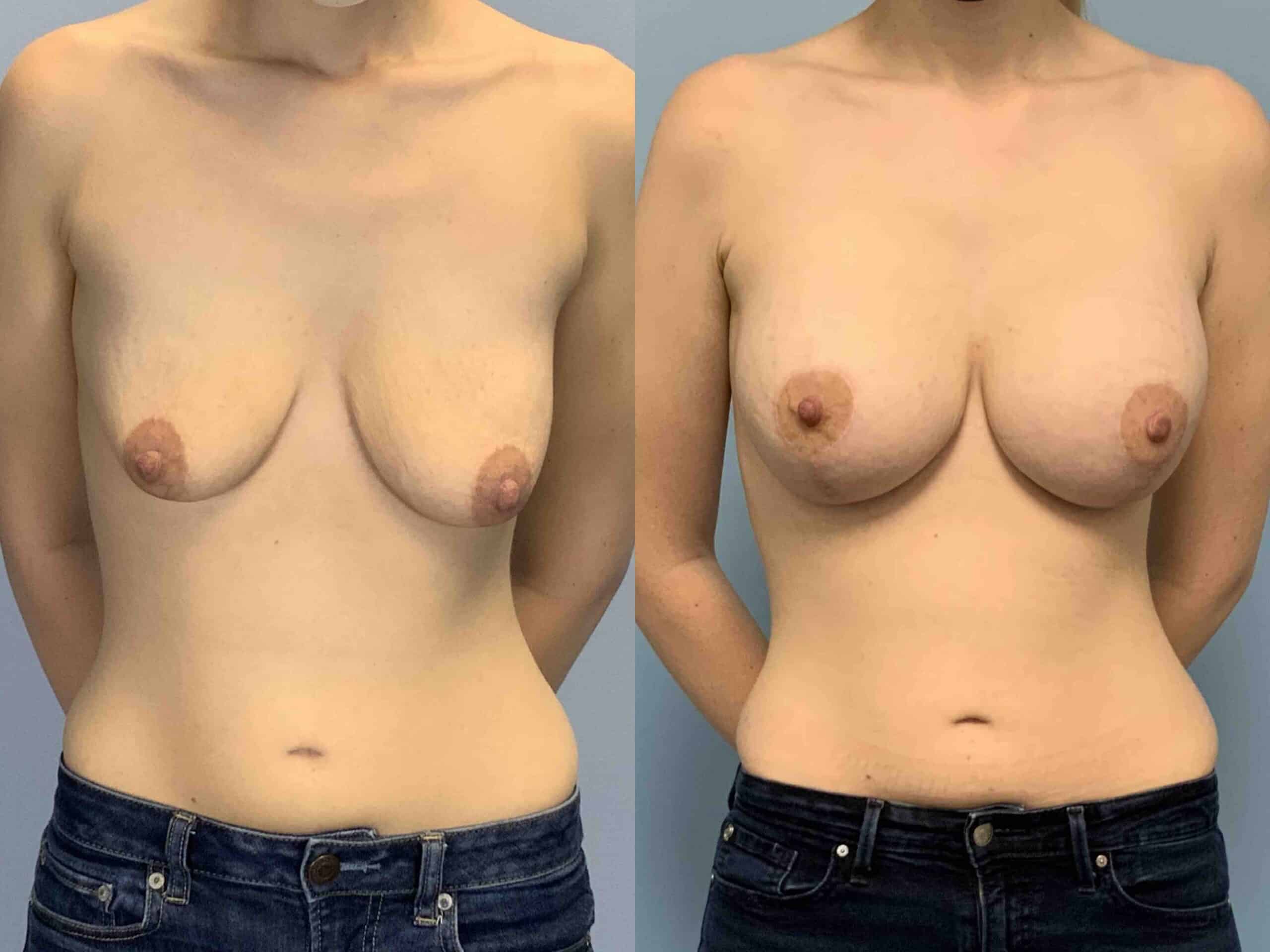 Before and after, 7 mo post op from Breast Augmentation, Strattice, Breast Lift/Mastopexy, performed by Dr. Paul Vanek (front view)