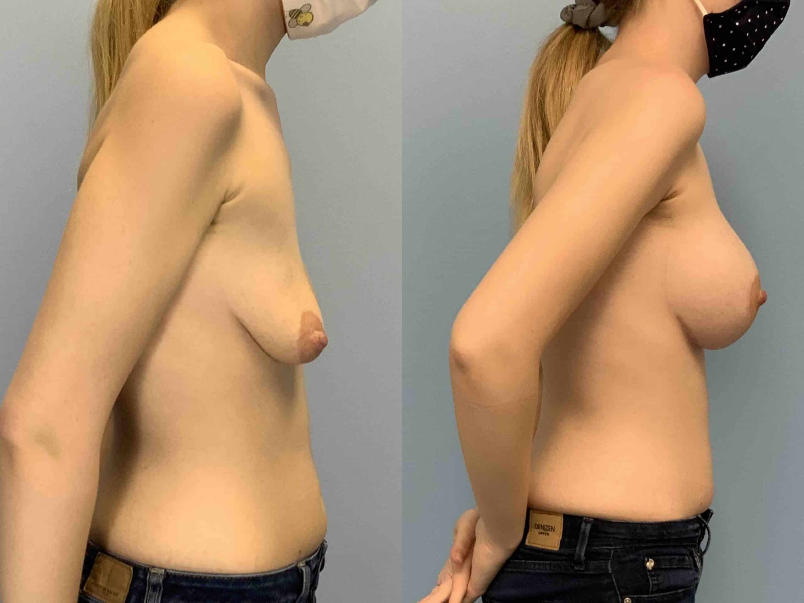 Before and after, 7 mo post op from Breast Augmentation, Strattice, Breast Lift/Mastopexy, performed by Dr. Paul Vanek (side view)