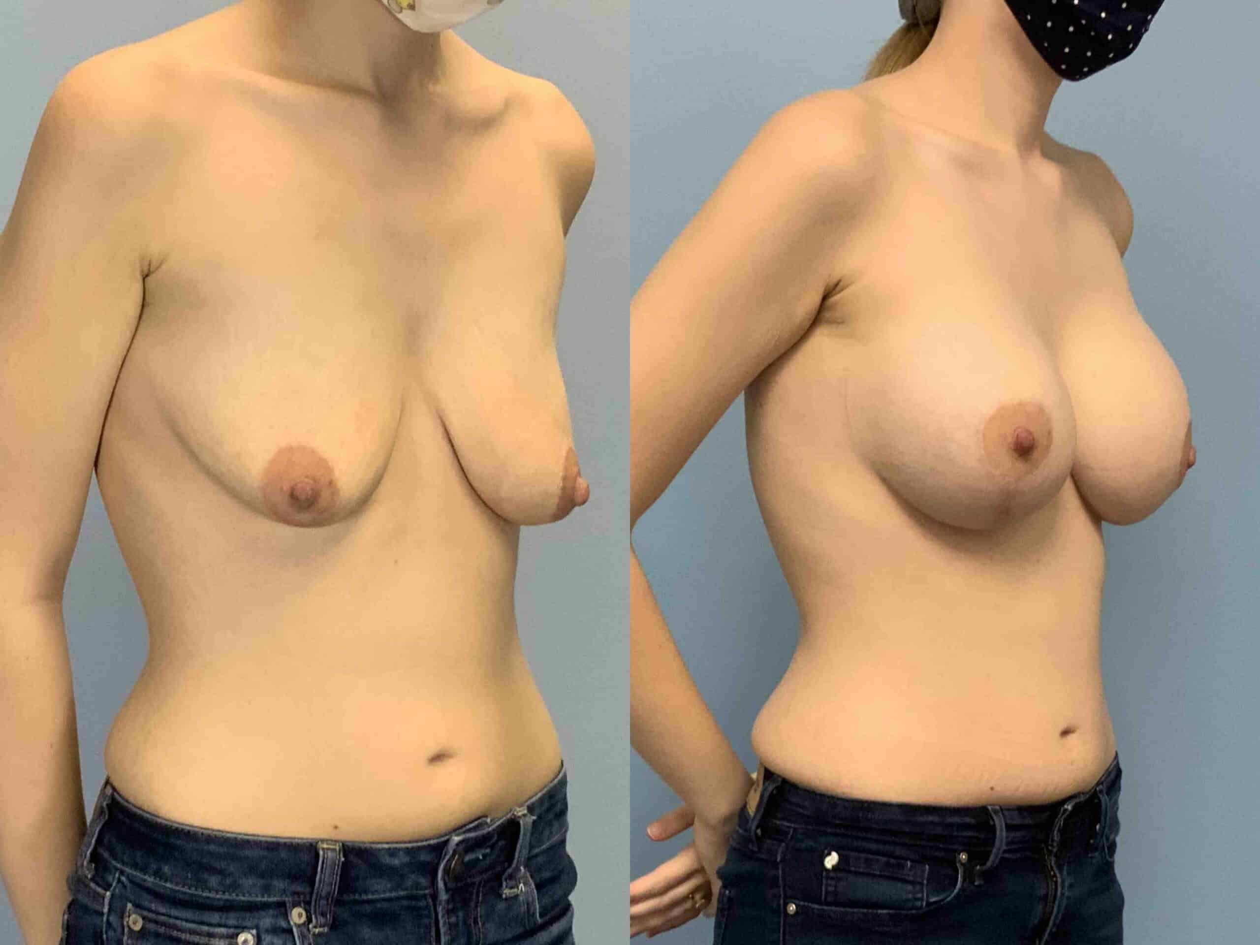 Before and after, 7 mo post op from Breast Augmentation, Strattice, Breast Lift/Mastopexy, performed by Dr. Paul Vanek (diagonal view)